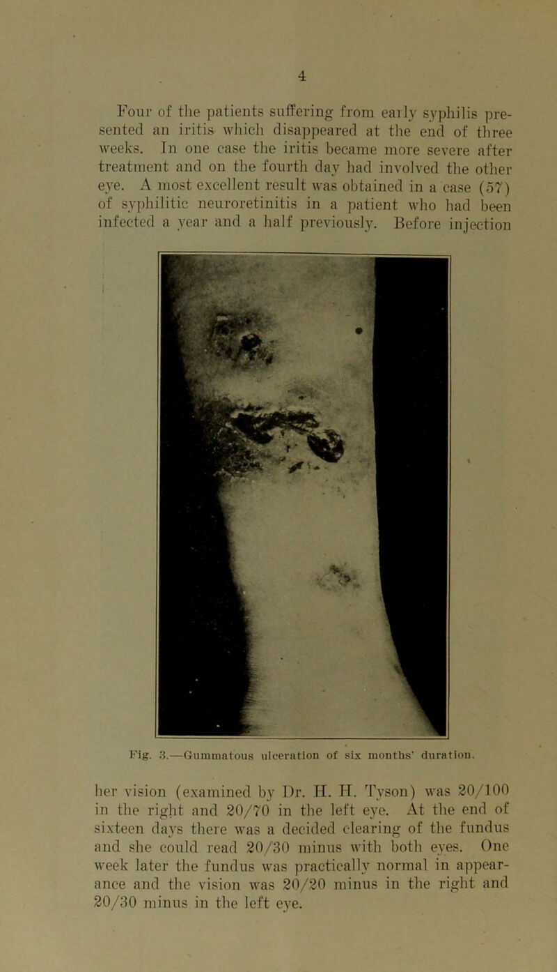 Four of the patients suffering from early syphilis pre- sented an iritis which disappeared at the end of three weeks. In one case the iritis became more severe after treatment and on the fourth day had involved the other eye. A most excellent result was obtained in a case (57) of syphilitic neuroretinitis in a patient who had been infected a year and a half previously. Before injection Fig. 3.—Gummatous ulceration of six months' duration. her vision (examined by Dr. H. H. Tyson) was 20/100 in the right and 20/70 in the left eye. At the end of sixteen days there was a decided clearing of the fundus and she could read 20/30 minus with both eyes. One week later the fundus was practically normal in appear- ance and the vision was 20/20 minus in the right and 20/30 minus in the left eye.