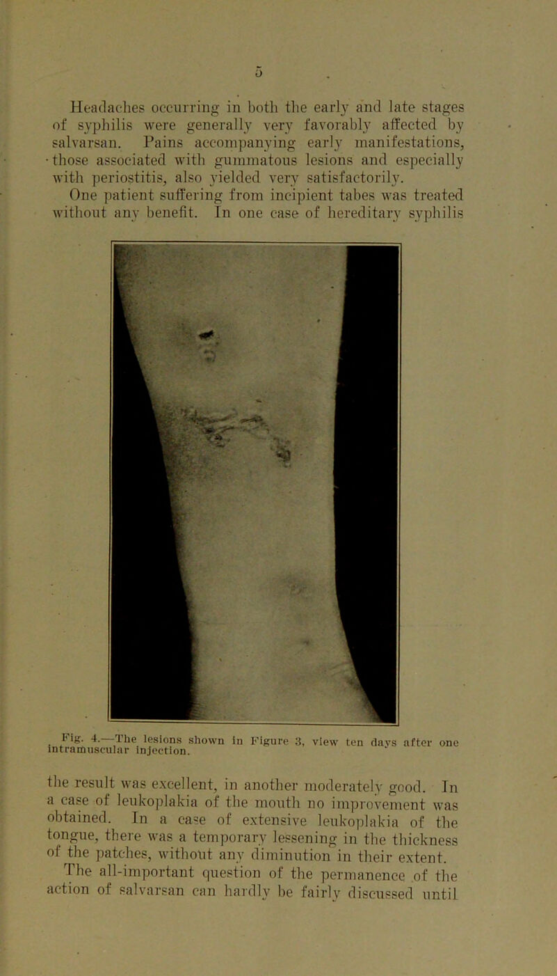 of syphilis were generally very favorably affected by salvarsan. Pains accompanying early manifestations, those associated with gummatous lesions and especially with periostitis, also yielded very satisfactorily. One patient suffering from incipient tabes was treated without any benefit. In one case of hereditary syphilis Fig. 4.—The lesions shown in intramuscular injection. Figure 3, view ten days after one the result was excellent, in another moderately good. In a case of leukoplakia of the mouth no improvement was obtained. In a case of extensive leukoplakia of the tongue, there was a temporary lessening in the thickness of the patches, without any diminution in their extent. The all-important question of the permanence of the action of salvarsan can hardly be fairly discussed until