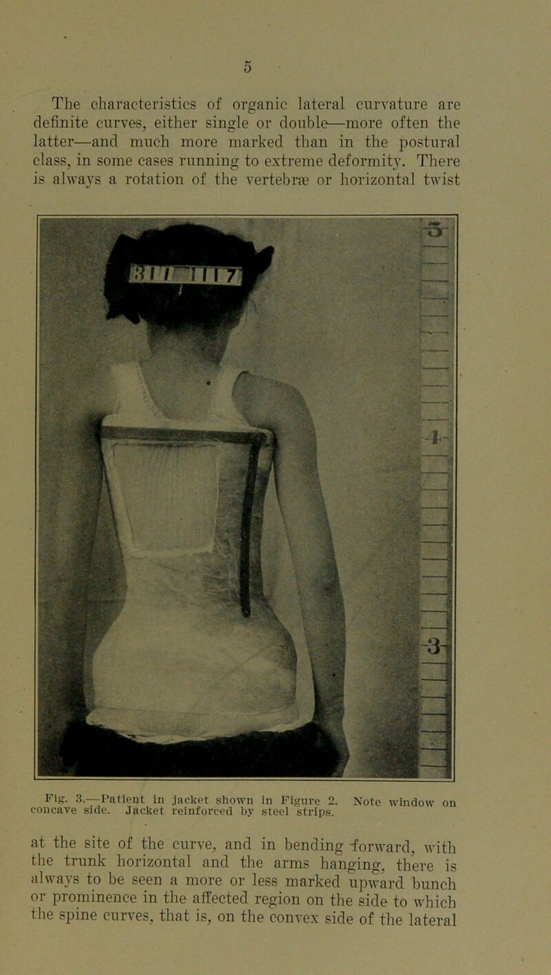 The characteristics of organic lateral curvature are definite curves, either single or double—more often the latter—and much more marked than in the postural class, in some cases running to extreme deformity. There is always a rotation of the vertebrae or horizontal twist Fig. 3.—Patient in jacket shown in Figure 2. Note window on concave side. Jacket reinforced by steel strips. at the site of the curve, and in bending -forward, with the trunk horizontal and the arms hanging, there is always to be seen a more or less marked upward bunch or prominence in the affected region on the side to which the spine curves, that is, on the convex side of the lateral