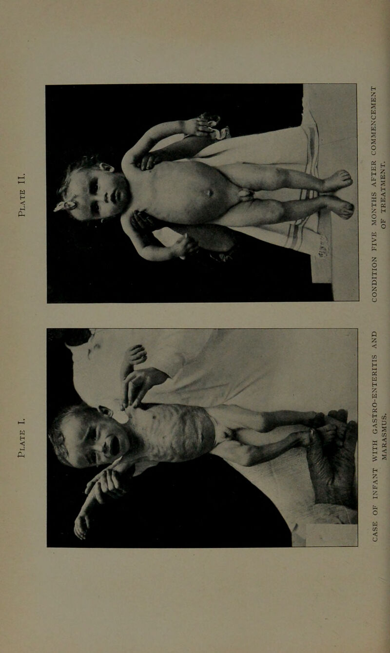 Plate I. Plate II. CASE OF INFANT WITH GASTRO-ENTERITIS AND CONDITION FIVE MONTHS AFTER COMMENCEMENT MARASMUS. OF TREATMENT.