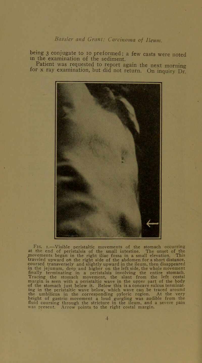 being 3 conjugate to 10 preformed; a few casts were noted in the examination of the sediment. Patient was requested to report again the next morning for x ray examination, but did not return. On inquiry Dr. Frc. 1.—Visible peristaltic movements of the stomach occurring at the end of peristalsis of the small intestine. The onset of the .movements began in the right iliac fossa in a small elevation. This traveled upward on the right side of the abdomen for a short distance, coursed transversely and slightly upward in the ileum, then disappeared in the jejunum, deep and higher on the left side, the whole movement finally terminating in a peristalsis involving the entire stomach. Tracing the stomach movement, the slant from the left costal margin is seen with a peristaltic wave in the upper part of the body of the stomach just below it. Below this is a concave sulcus terminat- ing in the peristaltic wave below, which wave can be traced around the umbilicus in the corresponding pyloric region. At the very height of gastric movement a loud gurgling was audible from the fluid coursing through the stricture in the ileum, and a severe pain was present. Arrow points to the right costal margin.