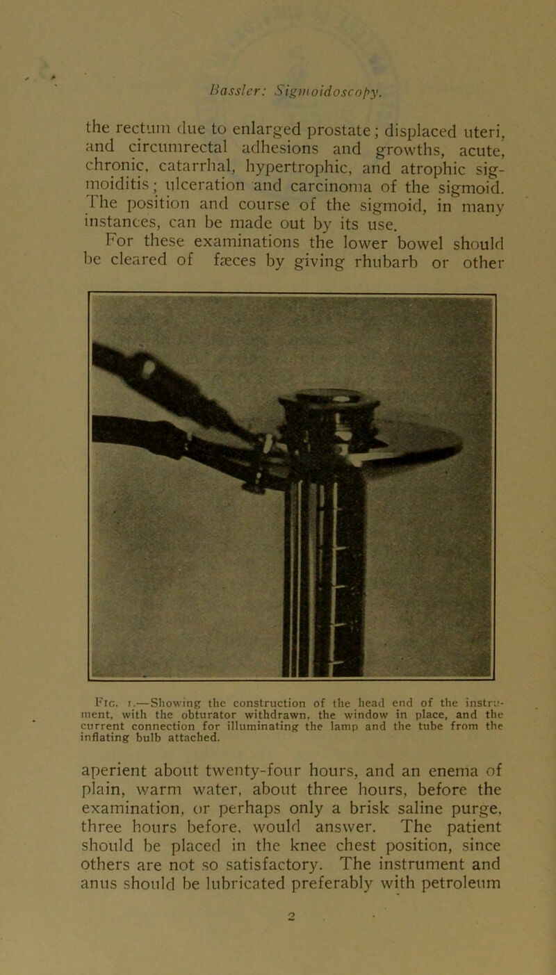 the rectum due to enlarged prostate; displaced uteri, and circumrectal adhesions and growths, acute’ chronic, catarrhal, hypertrophic, and atrophic sig- moiditis • ulceration and carcinoma of the sigmoid. The position and course of the sigmoid, in many instances, can be made out by its use. For these examinations the lower bowel should be cleared of feces by giving rhubarb or other Fig. i.—Showing the construction of the head end of the instru- ment, with the obturator withdrawn, the window in place, and the current connection for illuminating the lamp and the tube from the inflating bulb attached. aperient about twenty-four hours, and an enema of plain, warm water, about three hours, before the examination, or perhaps only a brisk saline purge, three hours before, would answer. The patient should be placed in the knee chest position, since others are not so satisfactory. The instrument and anus should be lubricated preferably with petroleum