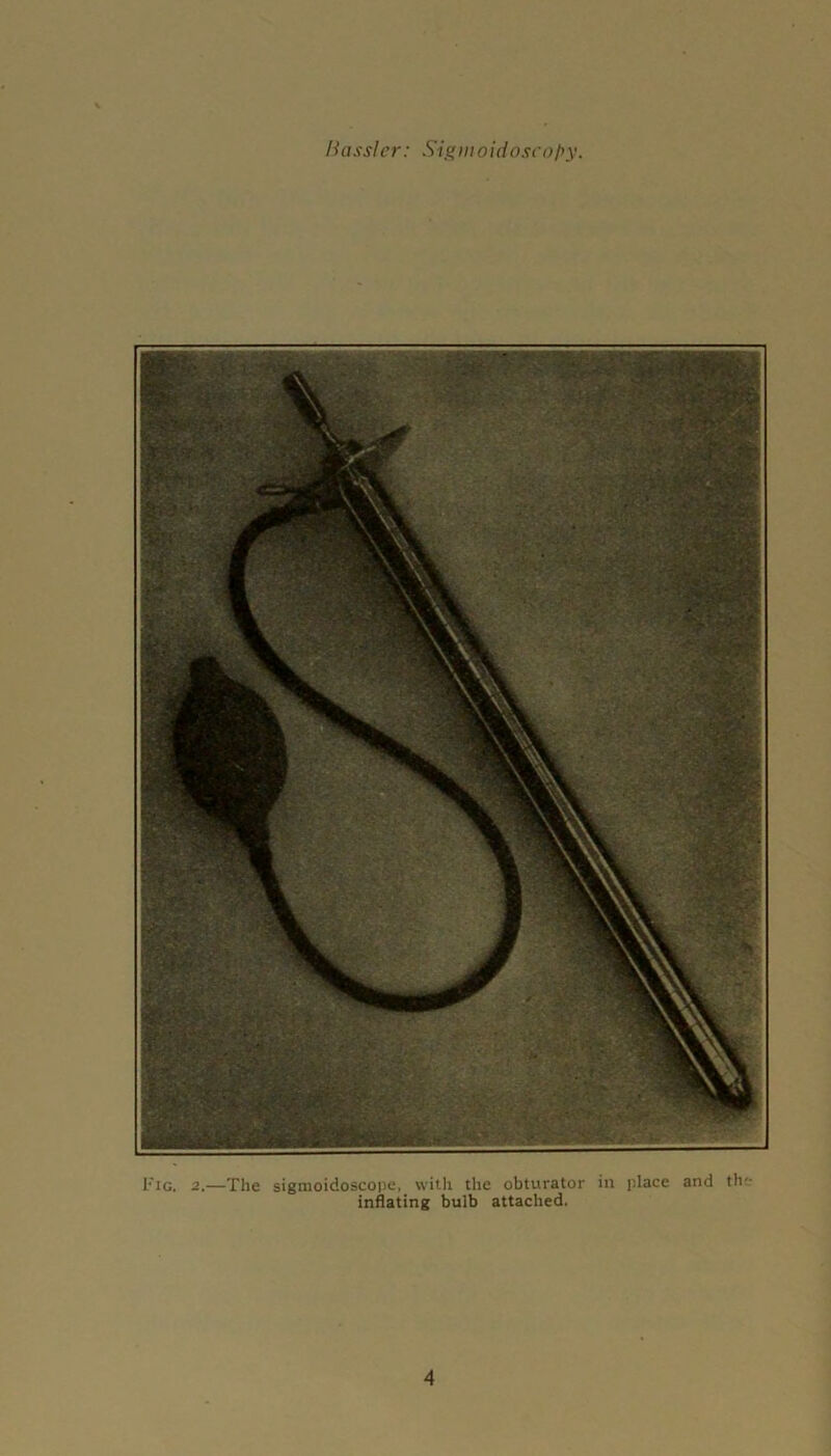 Fig. 2.—The sigmoidoscope,_ with the obturator inflating bulb attached. in place and the