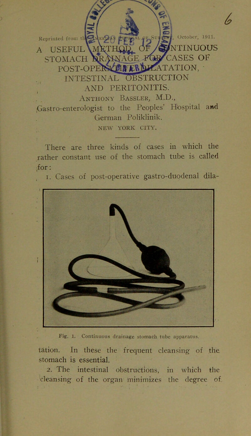 Reprinted from t A USEFUL STOMACH POST-O INTESTINAL October, 1911. NUOUS CASES OF ON, ' STRUCTION AND PERITONITIS. Anthony Bassler, M.D., jGastro-enterologist to the Peoples’ Hospital and German Poliklinik. & NEW YORK CITY. There are three kinds of cases in which the rather constant use of the stomach tube is called for: i. Cases of post-operative gastro-duodenal dila- Fig. 1. Continuous drainage stomach tube apparatus. t&tion. In these the frequent cleansing of the stomach is essential. 2. The intestinal obstructions, in which the cleansing of the organ minimizes the degree of