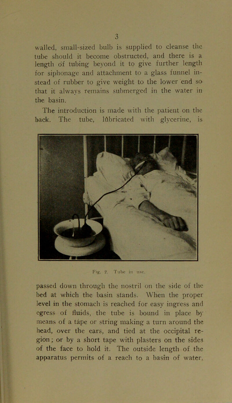 walled, small-sized bulb is supplied to cleanse the tube should it become obstructed, and there is a length of tubing beyond it to give further length for siphonage and attachment to a glass funnel in- stead of rubber to give weight to the lower end so that it always remains submerged in the water in the basin. The introduction is made with the patient on the back. The tube, lubricated with glycerine, is Fig. 2. Tube in use. passed down through the nostril on the side of the bed at which the basin stands. When the proper level in the stomach is reached for easy ingress and egress of fluids, the tube is bound in place by means of a tape or string making a turn around the head, over the ears, and tied at the occipital re- gion ; or by a short tape with plasters on the sides of the face to hold it. The outside length of the apparatus permits of a reach to a basin of water.
