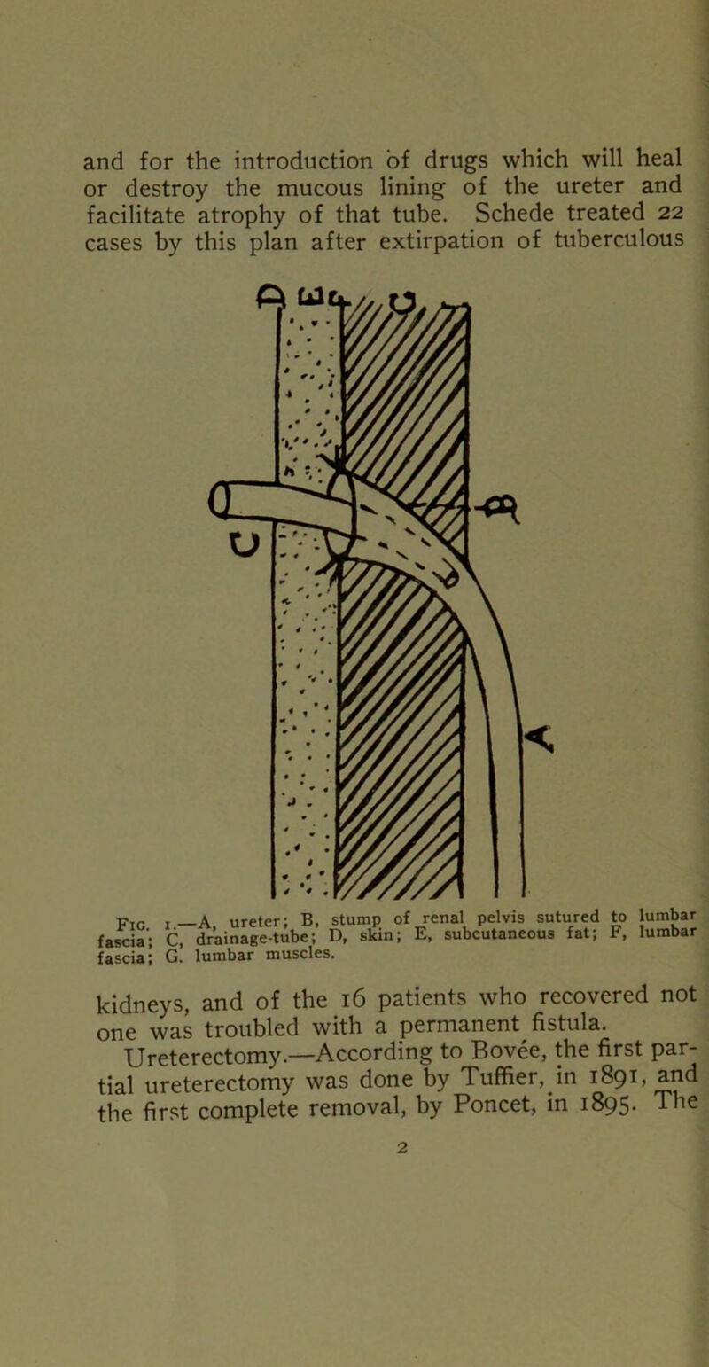 and for the introduction of drugs which will heal or destroy the mucous lining of the ureter and facilitate atrophy of that tube. Schede treated 22 cases by this plan after extirpation of tuberculous Fig , _a, ureter; B, stump of renal pelvis sutured to lumbar fascia'; C, drainage-tube; D, skin; E, subcutaneous fat; F, lumbar fascist \ G. lumbar muscles. kidneys, and of the 16 patients who recovered not one was troubled with a permanent fistula. Ureterectomy.—According to Bovee, the first par- tial ureterectomy was done by Tuffier, in 1891, and the first complete removal, by Poncet, in 1895. The