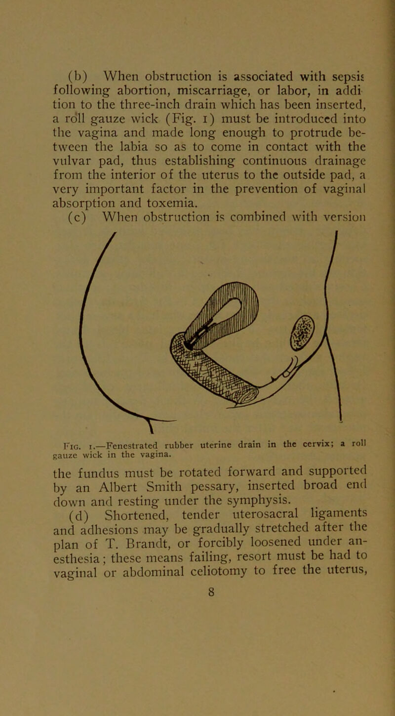 (b) When obstruction is associated with sepsis following abortion, miscarriage, or labor, in addi tion to the three-inch drain which has been inserted, a roll gauze wick (Fig. i) must be introduced into the vagina and made long enough to protrude be- tween the labia so as to come in contact with the vulvar pad, thus establishing continuous drainage from the interior of the uterus to the outside pad, a very important factor in the prevention of vaginal absorption and toxemia. (c) When obstruction is combined with version Fig. i.—Fenestrated rubber uterine drain in the cervix; a roll gauze wick in the vagina. the fundus must be rotated forward and supported by an Albert Smith pessary, inserted broad end down and resting under the symphysis. (d) Shortened, tender uterosacral ligaments and adhesions may be gradually stretched after the plan of T. Brandt, or forcibly loosened under an- esthesia ; these means failing, resort must be had to vaginal or abdominal celiotomy to free the uterus,