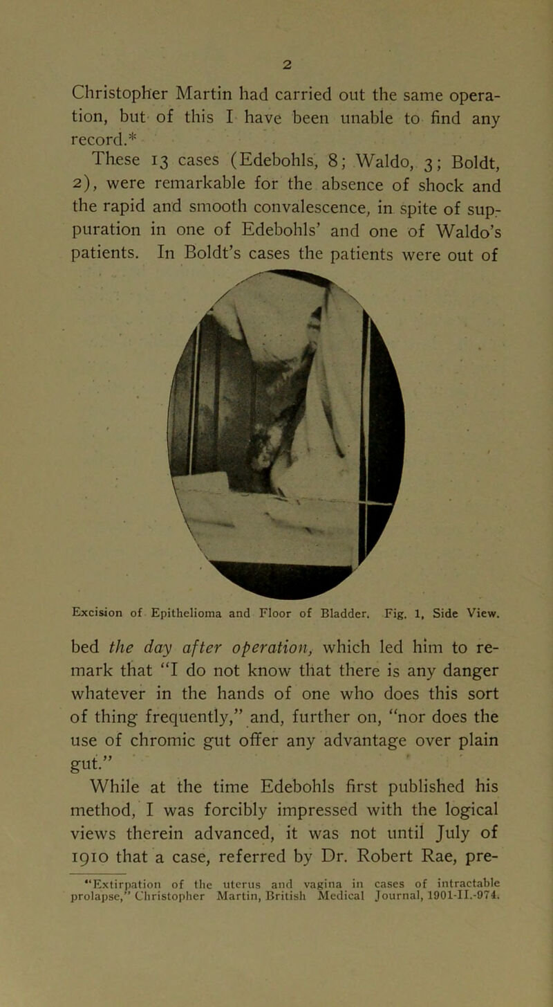 Christopher Martin had carried out the same opera- tion, but of this I have been unable to find any record.* These 13 cases (Edebohls, 8; Waldo, 3; Boldt, 2), were remarkable for the absence of shock and the rapid and smooth convalescence, in spite of sup- puration in one of Edebohls’ and one of Waldo’s patients. In Boldt’s cases the patients were out of Excision of Epithelioma and Floor of Bladder. Fig. 1, Side View. bed the day after operation, which led him to re- mark that “I do not know that there is any danger whatever in the hands of one who does this sort of thing frequently,” and, further on, “nor does the use of chromic gut offer any advantage over plain gut.” While at the time Edebohls first published his method, I was forcibly impressed with the logical views therein advanced, it was not until July of 1910 that a case, referred by Dr. Robert Rae, pre- “Extirpation of the uterus and vagina in cases of intractable prolapse,” Christopher Martin, British Medical Journal, 1901-II.-974.