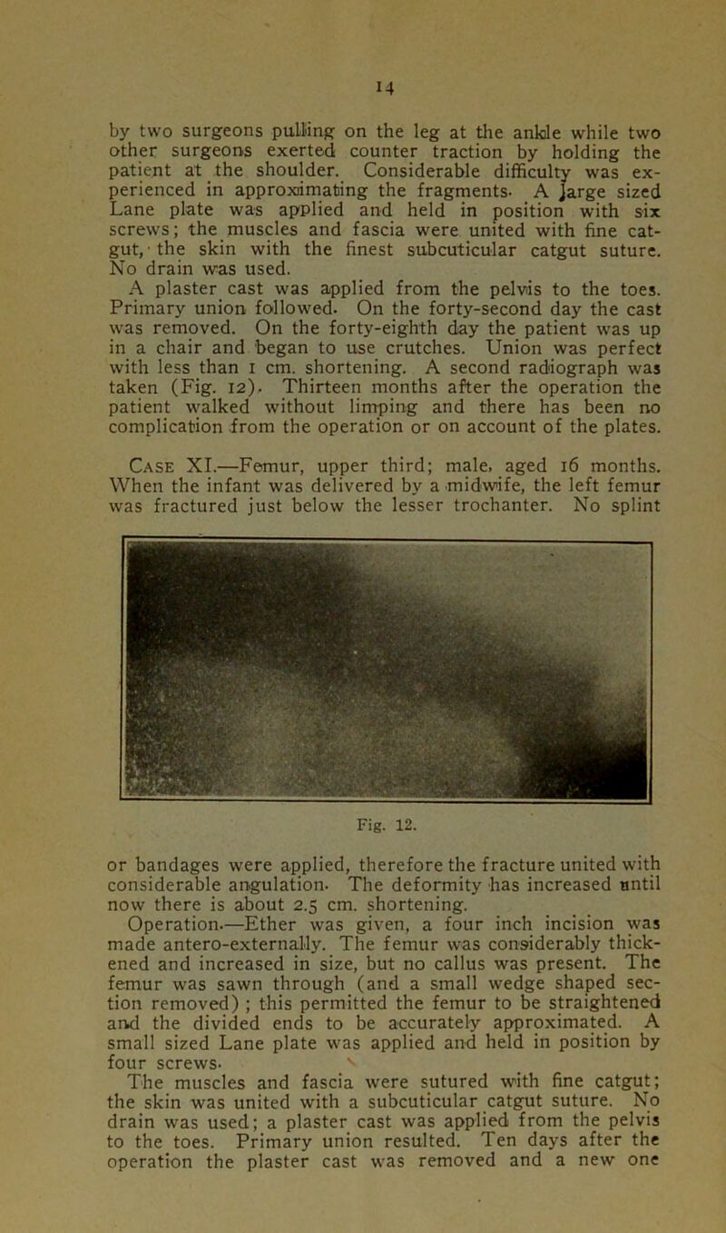 by two surgeons pulling on the leg at the ankle while two other surgeons exerted counter traction by holding the patient at the shoulder. Considerable difficulty was ex- perienced in approxiimating the fragments- A Jarge sized Lane plate was applied and held in position with six screws; the muscles and fascia were united with fine cat- gut, ■ the skin with the finest subcuticular catgut suture. No drain was used. A plaster cast was applied from the pelvis to the toes. Primary union followed. On the forty-second day the cast was removed. On the forty-eighth day the patient was up in a chair and began to use crutches. Union was perfect with less than i cm. shortening. A second radiograph was taken (Fig. 12). Thirteen months after the operation the patient walked without limping and there has been no complication from the operation or on account of the plates. Case XI.—Femur, upper third; male, aged 16 months. When the infant was delivered by a midwife, the left femur was fractured just below the lesser trochanter. No splint Fig. 12. or bandages were applied, therefore the fracture united with considerable angulation. The deformity has increased until now there is about 2.5 cm. shortening. Operation.—Ether was given, a four inch incision was made antero-externally. The femur was considerably thick- ened and increased in size, but no callus was present. The femur was sawn through (and a small wedge shaped sec- tion removed) ; this permitted the femur to be straightened and the divided ends to be accurately approximated. A small sized Lane plate was applied and held in position by four screws. The muscles and fascia were sutured with fine catgut; the skin was united with a subcuticular catgut suture. No drain was used; a plaster cast was applied from the pelvis to the toes. Primary union resulted. Ten days after the operation the plaster cast was removed and a new one