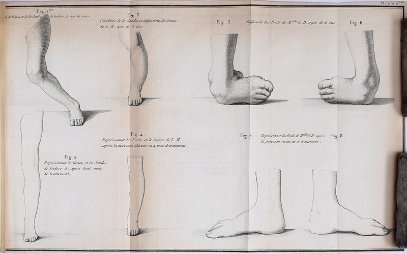 Courbure t/e /a Jvnbe et d///ormité t/u Genou t/e Z. .J/. ut/e' t/e 3 uns . Fig.4- Représentant Zti Janile et Ze Ce/tou t/e Z .Æ. après Zut/7tort son obtenue en y.’> mois t/e traitement. Pi O' .2. . o Reprèsenta/d le Genou et lu Jambe t/e Isi/lo/'e J . après /ait mois de ù'alternent . TTaiïcIio 2 cmc Fig • . Représentant ZesJbet/s deJ[tffeZJt après Fi o'. 8 . /a (fuérison en un an de traitement .