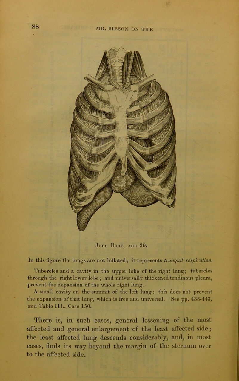 MR. STBSON ON TIIE Joel Boot, age 39. In this figure the lungs are not inflated; it represents tranquil respiration. Tubercles and a cavity in the upper lobe of the right lung; tubercles through the right lower lobe; and universally thickened tendinous pleura, prevent the expansion of the whole right lung. A small cavity on the summit of the left lung: this does not prevent the expansion of that lung, which is free and universal. See pp. 438-443, and Table III., Case 150. There is, in such cases, general lessening of the most affected and general enlargement of the least affected side; the least affected lung descends considerably, and, in most cases, finds its way beyond the margin of the sternum over to the affected side.