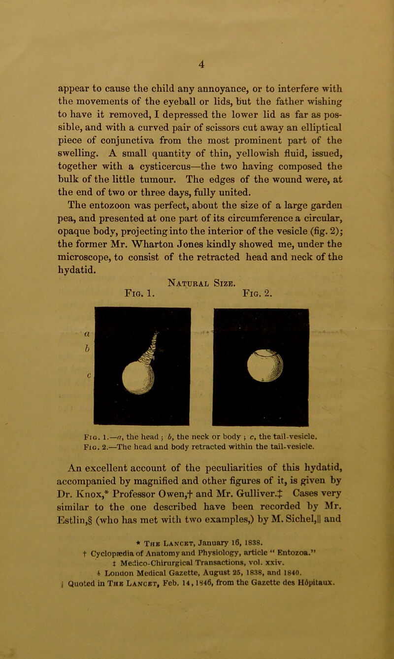 appear to cause the child any annoyance, or to interfere with the movements of the eyeball or lids, but the father wishing to have it removed, I depressed the lower lid as far as pos- sible, and with a curved pair of scissors cut away an elliptical piece of conjunctiva from the most prominent part of the swelling. A small quantity of thin, yellowish fluid, issued, together with a cysticercus—the two having composed the bulk of the little tumour. The edges of the wound were, at the end of two or three days, fully united. The entozoon was perfect, about the size of a large garden pea, and presented at one part of its circumference a circular, opaque body, projecting into the interior of the vesicle (fig. 2); the former Mr. Wharton Jones kindly showed me, under the microscope, to consist of the retracted head and neck of the hydatid. Natural Size. Fig. 1. Fig. 2. Fig. l.—a, the head ; b, the neck or body ; c, the tail-vesicle. Fio. 2.—The head and body retracted within the tail-vesicle. An excellent account of the peculiarities of this hydatid, accompanied by magnified and other figures of it, is given by Dr. Knox,* Professor Owen,+ and Mr. Gulliver.J Cases very similar to the one described have been recorded by Mr. Estlin,§ (who has met with two examples,) by M. Sichel,|| and * Tub Lanckt, January l6, 1838. t Cyclopsedia of Anatomy and Physiolog^^, article “ Entozoa.” t Medico-Chlrurgical Transactions, vol. xxiv. i London Medical Gazette, August 25, 1838, and 1840. 1 Quoted in Tub Lancet, Feb. 14,1846, from the Gazette des H6pitaux.