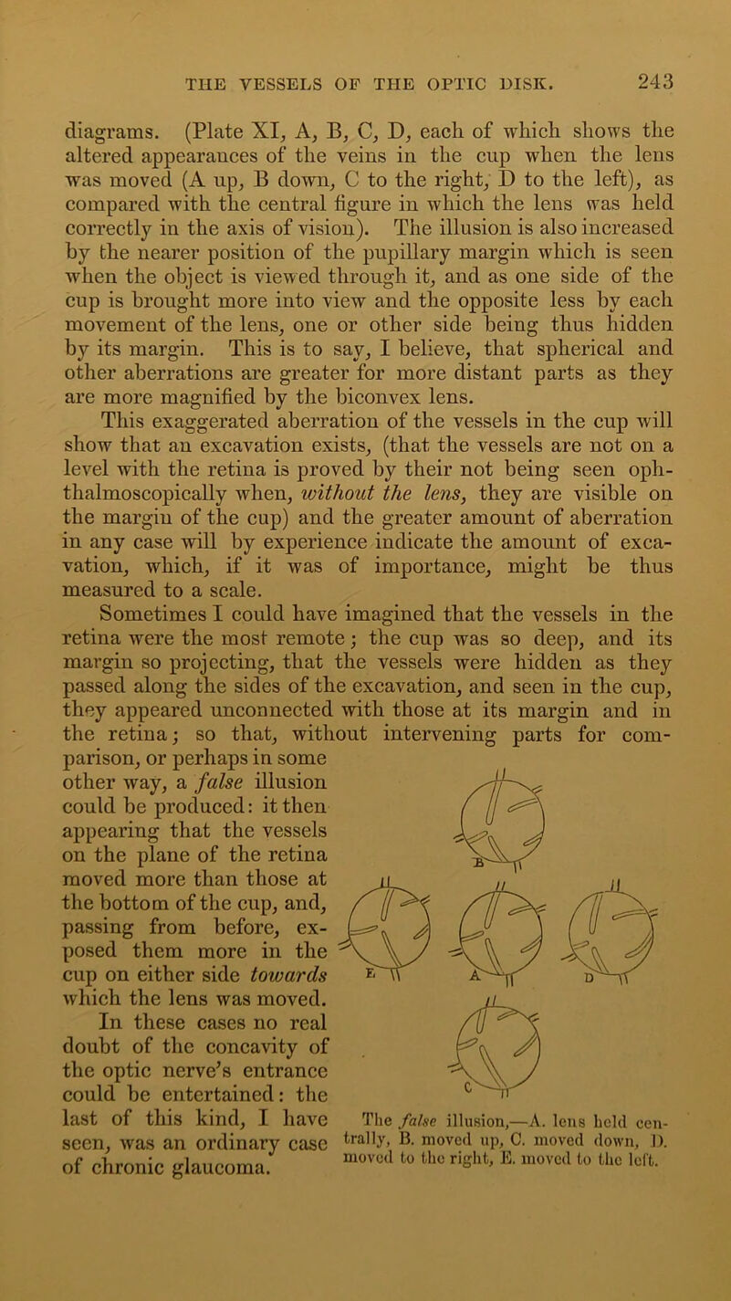 diagrams. (Plate XI, A, B, C, D, each of which shows the altered appearances of the veins in the cup when the lens was moved (A up, B down, C to the right, D to the left), as compared with the central figure in which the lens was held correctly in the axis of vision). The illusion is also increased by the nearer position of the pupillary margin which is seen when the object is viewed through it, and as one side of the cup is brought more into view and the opposite less by each movement of the lens, one or other side being thus hidden by its margin. This is to say, I believe, that spherical and other aberrations are greater for more distant parts as they are more magnified by the biconvex lens. This exaggerated aberration of the vessels in the cup will show that an excavation exists, (that the vessels are not on a level with the retina is proved by their not being seen oph- thalmoscopically when, without the lens, they are visible on the margin of the cup) and the greater amount of aberration in any case will by experience indicate the amount of exca- vation, which, if it was of importance, might be thus measured to a scale. Sometimes I could have imagined that the vessels in the retina were the most remote; the cup was so deep, and its margin so projecting, that the vessels were hidden as they passed along the sides of the excavation, and seen in the cup, they appeared unconnected with those at its margin and in the retina; so that, without intervening parts for com- parison, or perhaps in some other way, a false illusion could be produced: it then appearing that the vessels on the plane of the retina moved more than those at the bottom of the cup, and, passing from before, ex- posed them more in the cup on either side towards which the lens was moved. In these cases no real doubt of the concavity of the optic nerve’s entrance could be entertained: the last of this kind, I have seen, was an ordinary case of chronic glaucoma. The false illusion,—A. lens held cen- trally, 13. moved up, C. moved down, D. moved to the right, E. moved to the left.