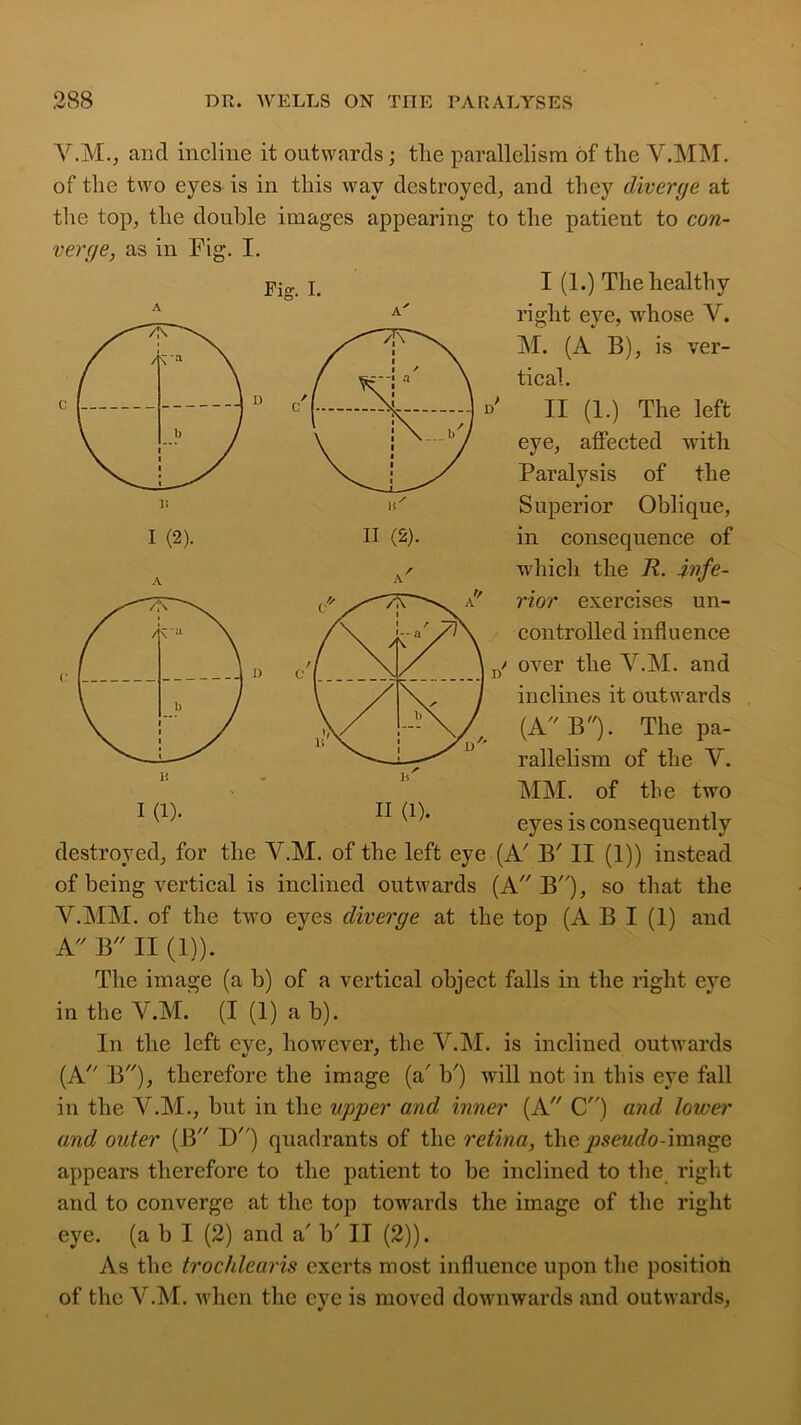 Fig. I. I (2). II (2). V.M., and incline it outwards; the parallelism of the V.MM. of the two eyes is in this way destroyed, and they diverge at the top, the double images appearing to the patieut to con- verge, as in Fig. I. I (1.) The healthy right eye, whose V. M. (A B), is ver- tical. ' II (1.) The left eye, affected with Paralysis of the Superior Oblique, in consequence of which the R. infe- rior exercises un- controlled influence / over the Y.M. and inclines it outwards (A B). The pa- rallelism of the Y. MM. of the two eyes is consequently destroyed, for the Y.M. of the left eye (A' B' II (1)) instead of being vertical is inclined outwards (A B), so that the V.MM. of the two eyes diverge at the top (A B I (1) and A. B II (1)). The image (a b) of a vertical object falls in the right eye in the Y.M. (I (1) a b). In the left eye, however, the Y.M. is inclined outwards (A B), therefore the image (a' b') will not in this eye fall in the Y.M., but in the upper and inner (A C) and lower and outer (B D) quadrants of the retina, the pseudo-\mngQ appears therefore to the patient to be inclined to the right and to converge at the top towards the image of the right eye. (a b I (2) and a' b' II (2)). As the trochlearis exerts most influence upon the position of the Y.M. when the eye is moved downwards and outwards. 1(1).