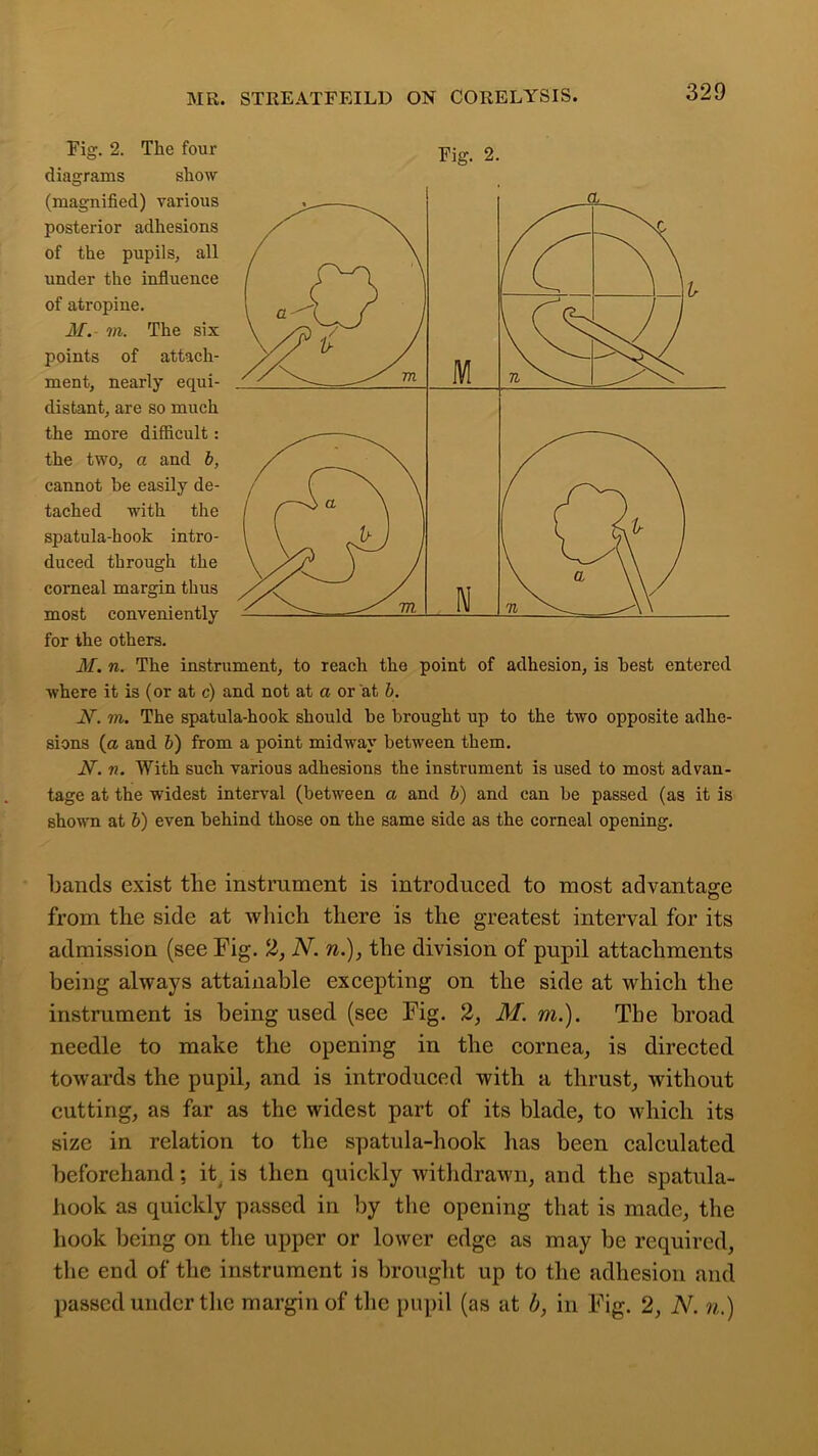 Fig. 2. The four diagrams show (magnified) various posterior adhesions of the pupils, all under the influence of atropine. M. to. The six points of attach- ment, nearly equi- distant, are so much the more difficult : the two, a and b, cannot he easily de- tached with the spatula-hook intro- duced through the corneal margin thus most conveniently for the others. M. n. The instrument, to reach the point of adhesion, is best entered where it is (or at c) and not at a or at b. JV. to. The spatula-hook should be brought up to the two opposite adhe- sions (a and b) from a point midway between them. If. n. With such various adhesions the instrument is used to most advan- tage at the widest interval (between a and b) and can be passed (as it is shown at b) even behind those on the same side as the corneal opening. bands exist the instrument is introduced to most advantage from the side at which there is the greatest interval for its admission (see Fig. 2, N. n.), the division of pupil attachments being always attainable excepting on the side at which the instrument is being used (see Fig. 2, M. m.). The broad needle to make the opening in the cornea, is directed toAvards the pupil, and is introduced with a thrust, without cutting, as far as the widest part of its blade, to which its size in relation to the spatula-hook lias been calculated beforehand; it is then quickly withdrawn, and the spatula- hook as quickly passed in by the opening that is made, the hook being on the upper or lower edge as may be required, the end of the instrument is brought up to the adhesion and passed under the margin of the pupil (as at b, in Fig. 2, N. n.)