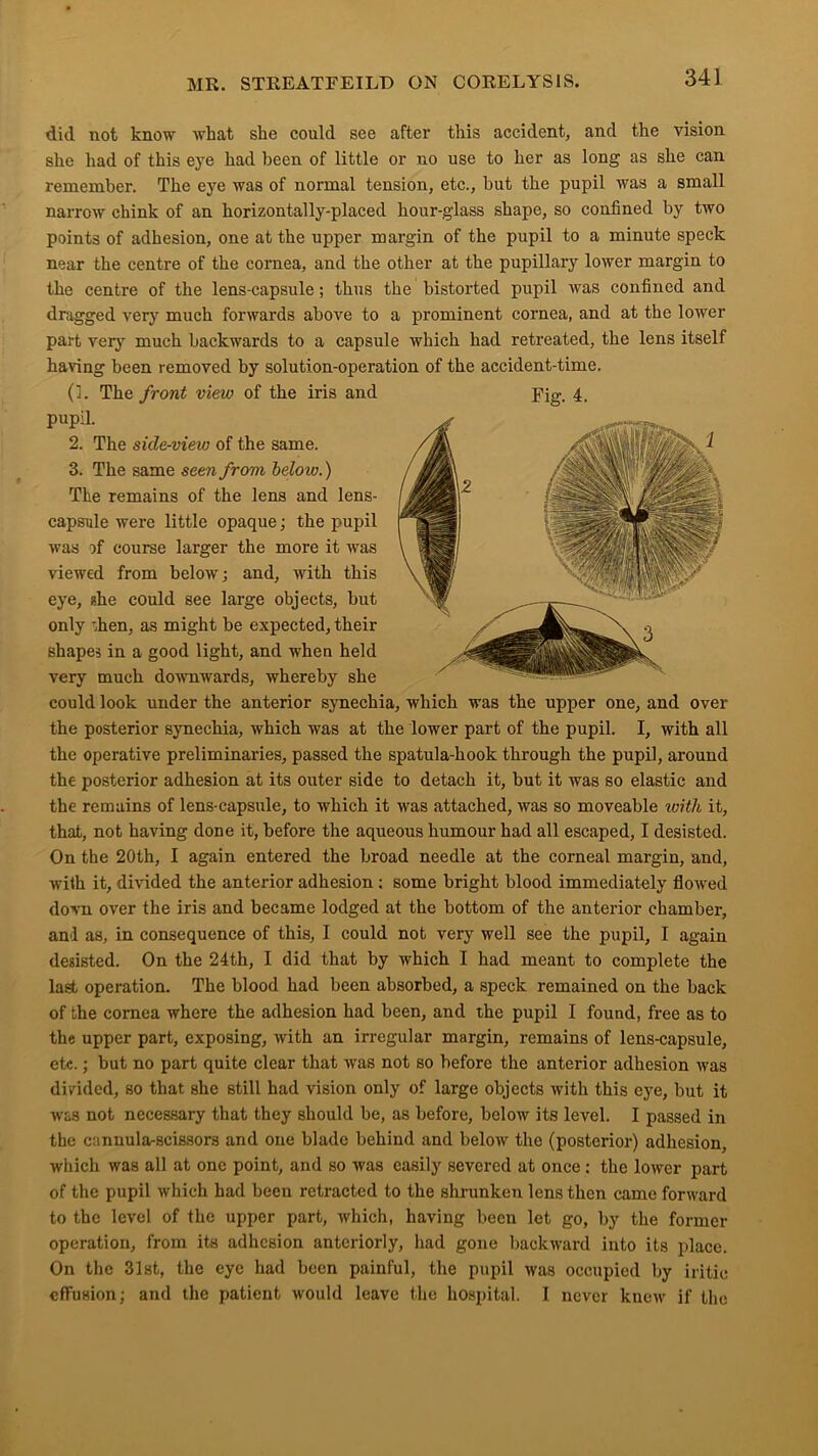 did not know what she could see after this accident, and the vision she had of this eye had been of little or no use to her as long as she can remember. The eye was of normal tension, etc., but the pupil was a small narrow chink of an horizontally-placed hour-glass shape, so confined by two points of adhesion, one at the upper margin of the pupil to a minute speck near the centre of the cornea, and the other at the pupillary lower margin to the centre of the lens-capsule; thus the bistorted pupil was confined and dragged very much forwards above to a prominent cornea, and at the lower part very much backwards to a capsule which had retreated, the lens itself having been removed by solution-operation of the accident-time. Fig. 4. (1. The front view of the iris and pupil. 2. The side-view of the same. 3. The same seen from below.) The remains of the lens and lens- capsule were little opaque; the pupil was if course larger the more it was viewed from below j and, with this eye, she could see large objects, but only ihen, as might be expected, their shapes in a good light, and when held very much downwards, whereby she could look under the anterior synechia, which was the upper one, and over the posterior synechia, which was at the lower part of the pupil. I, with all the operative preliminaries, passed the spatula-hook through the pupil, around the posterior adhesion at its outer side to detach it, but it was so elastic and the remains of lens-capsule, to which it was attached, was so moveable with it, that, not having done it, before the aqueous humour had all escaped, I desisted. On the 20th, I again entered the broad needle at the corneal margin, and, with it, divided the anterior adhesion; some bright blood immediately flowed dovu over the iris and became lodged at the bottom of the anterior chamber, and as, in consequence of this, I could not very well see the pupil, I again desisted. On the 24th, I did that by which I had meant to complete the last operation. The blood had been absorbed, a speck remained on the back of the cornea where the adhesion had been, and the pupil I found, free as to the upper part, exposing, with an irregular margin, remains of lens-capsule, etc.; but no part quite clear that was not so before the anterior adhesion was divided, so that she still had vision only of large objects with this eye, but it was not necessary that they should be, as before, below its level. I passed in the cannula-scissors and one blade behind and below the (posterior) adhesion, which was all at one point, and so was easily severed at once: the lower part of the pupil which had been retracted to the shrunken lens then came forward to the level of the upper part, which, having been let go, by the former operation, from its adhesion anteriorly, had gone backward into its place. On the 31st, the eye had been painful, the pupil was occupied by iritic effusion; and the patient would leave the hospital. I never knew if the