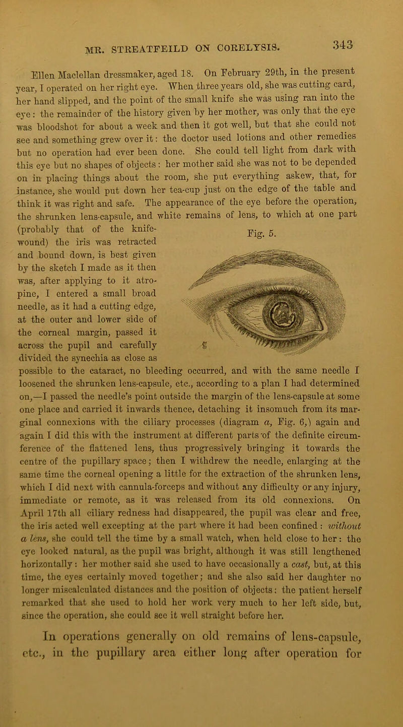 Ellen Maclellan dressmaker, aged 18. On February 29th, in the present year, I operated on her right eye. When three years old, she was cutting caid, her hand slipped, and the point of the small knife she was using ran into the eye: the remainder of the history given by her mother, was only that the eye was bloodshot for about a week and then it got well, but that she could not see and something grew over it: the doctor used lotions and other remedies but no operation had ever been done. She could tell light from dark with this eye but no shapes of objects: her mother said she was not to be depended on in placing things about the room, she put everything askew, that, for instance, she would put down her tea-cup just on the edge of the table and think it was right and safe. The appearance of the eye before the operation, the shrunken lens-capsule, and white remains of lens, to which at one part (probably that of the knife- wound) the iris was retracted and bound down, is best given by the sketch I made as it then was, after applying to it atro- pine, I entered a small broad needle, as it had a cutting edge, at the outer and lower side of the corneal margin, passed it across the pupil and carefully divided the synechia as close as possible to the cataract, no bleeding occurred, and with the same needle I loosened the shrunken lens-capsule, etc., according to a plan I had determined on,—I passed the needle’s point outside the margin of the lens-capsule at some one place and carried it inwards thence, detaching it insomuch from its mar- ginal connexions with the ciliary processes (diagram a, Fig. 6,) again and again I did this with the instrument at different parts of the definite circum- ference of the flattened lens, thus progressively bringing it towards the centre of the pupillary space; then I withdrew the needle, enlarging at the same time the corneal opening a little for the extraction of the shrunken lens, which I did next with cannula-forceps and without any difficulty or any injury, immediate or remote, as it was released from its old connexions. On April 17th all ciliary redness had disappeared, the pupil was clear and free, the iris acted well excepting at the part where it had been confined : without a lens, she could tell the time by a small watch, when held close to her: the eye looked natural, as the pupil was bright, although it was still lengthened horizontally: her mother said she used to have occasionally a cast, but, at this time, the eyes certainly moved together; and she also said her daughter no longer miscalculated distances and the position of objects: the patient herself remarked that she used to hold her work very much to her left side, but, since the operation, she could see it well straight before her. In operations generally on old remains of lens-capsule, etc., in the pupillary area either long after operation for Fig. 5.