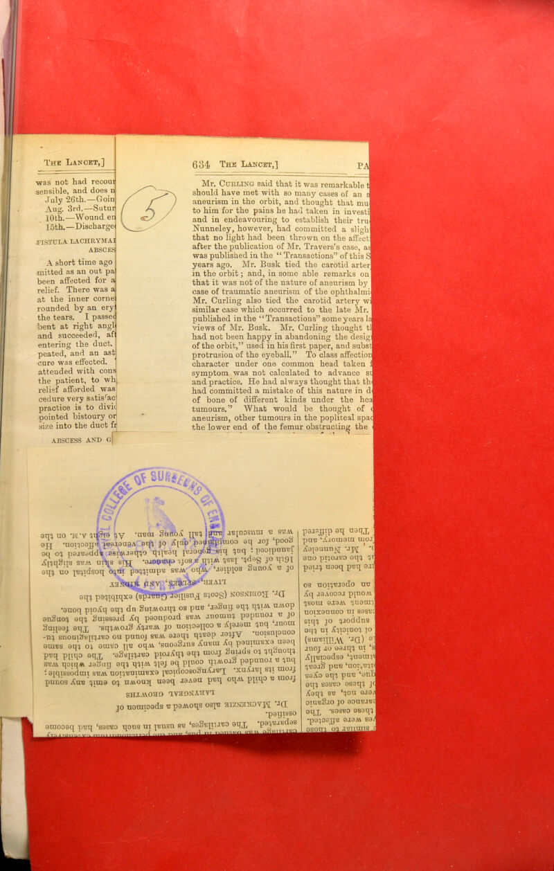 The Lancet,] was not had recoui sensible, and does n July 26th.—Goin Aug. 3rd.—Sutur 10th.—Wound en loth.—Discharge FISTULA LACHRYMAI ABSCES A short time ago mitted as an out pa been affected for a relief. There was a at the inner corne rounded by an ery the tears. I passec bent at right angl and succeeded, af enteriug the duct peated, and an ast •cure was effected, attended with cons the patient, to wh relief afforded was cedure very satisrac practice is to divit pointed bistoury or size into the duct ft 634 The Lancet,] Mr. Curling said that it was remarkable 1 should have met with so many cases of an J aneurism in the orbit, and thought that mul to him for the pains he had taken in investil and in endeavouring to establish their trul Nunneley, however, had committed a slighl that no light had been thrown on the affectl after the publication of Mr. Travers’s case, as[ was published in the “ Transactions” of this ! years ago. Mr. Busk tied the carotid arterl in the orbit; and, in some able remarks on] that it was not of the nature of aneurism by case of traumatic aneurism of the ophthalmi] Mr. Curling also tied the carotid artery w] similar case which occurred to the late Mr. published in the “Transactions” some years h views of Mr. Busk. Mr. Curling thought til had not been happy in abandoning the desig] of the orbit,” used in his first paper, and substl protrusion of the eyeball.” To class affectior character under one common head taken symptom was not calculated to advance sJ and practice. He had always thought that tkJ had committed a mistake of this nature in dl of bone of different kinds under the heal tumours.” What would be thought of aneurism, other tumours in the popliteal spacj the lower end of the femur obstructing the ABSCESS AND G * %, fcjf/ . .a \w, •aura SunoA jjuj jgTiu auposnui u bum >3(h 0qj uo -jai-v tqSta v u - - ju, > t „ eyr •noqoonu luaaauaA eqj jo A[uo paupqdmoo aq joj poo« oq oj paauadde asiMaaqjo qqpuaq jeaaaaS eiq !}nq 1 paoipunrL Amqgqs sum unis sijj -aaopuqo 'Jjosu qjiM t>suj pdas jo qq,9l oqj uo jupdsoq ojui papirapu sum oqM ‘aaipjos «unoA u jo A3NCLIH aMV ‘NaSUcCS klSAlT oqj pejiqiqxa (spaunQ aaqisn^j slO0S) NOStnaoH JCT •auoq pioA’q aqj dn gutMO.iqi os puu tiaSuq aqj q?m uMop anguoj aqj Smssaad Aq paonpoad sum anoumj papnuoa^ u jo 3uii99i eqr -sqjMoag AjauM jo uopoanoo u Apaam qnq unora -n^ snoaigujijauo ou punoj sum aaaqj qquap aaqjv uoisnpuoo emus aqj oj oraUo tiu oqM ‘suoaSans Auura Aq pauiuiuxa uaaq puq pnqo oqj -agtqpauo pioaAqj 0qj uuojj ffuuas oj qq/moqj sum qoiqM aohuu aqj qjiM qpj oq PI00 qi^oa*. papano.i a. quq faiqissodrai sum uoijummuxa juoidoosoSuAau'q xuAauj sqi rao.ij punos Auu juua oj UMoaq uaaq J3A9U puq oqM ppqo u tuo.ij SHXAVOUD avaDNAHVT to uounoads u paMoqs ospc suzNflNOvpi JQ[ •paqisso atnooaq puq ‘sasuo qons ui junsn su ‘saSupqauo aqj, pajjuaudas paasgip aq aaqj, puu ‘Aa otnara raoJj Aopuunjq -jj\[ ano piqoavo equ qt pauq. uaaq puq oral os nopuaado uu Aq aaaooaa ppioM !jsora e.iaA\ quauril uoixauuoo m sasu;[ slip jo jaoddns aip ui Aqioiuoq jo (smuin^vv ,ja) °i anoj ao oaaqj ut ‘a Aquioadsa ‘juoraq'j ^uoaS puu ‘aoivuqp| saAa aqi puu ‘an! oqj sasua asaqj j( Aaqq su ‘qou oaa/ oiuuSao jo aouuaut 8MX -sasuo asaqjl •pajoa^u oaaM sa/ oi auT