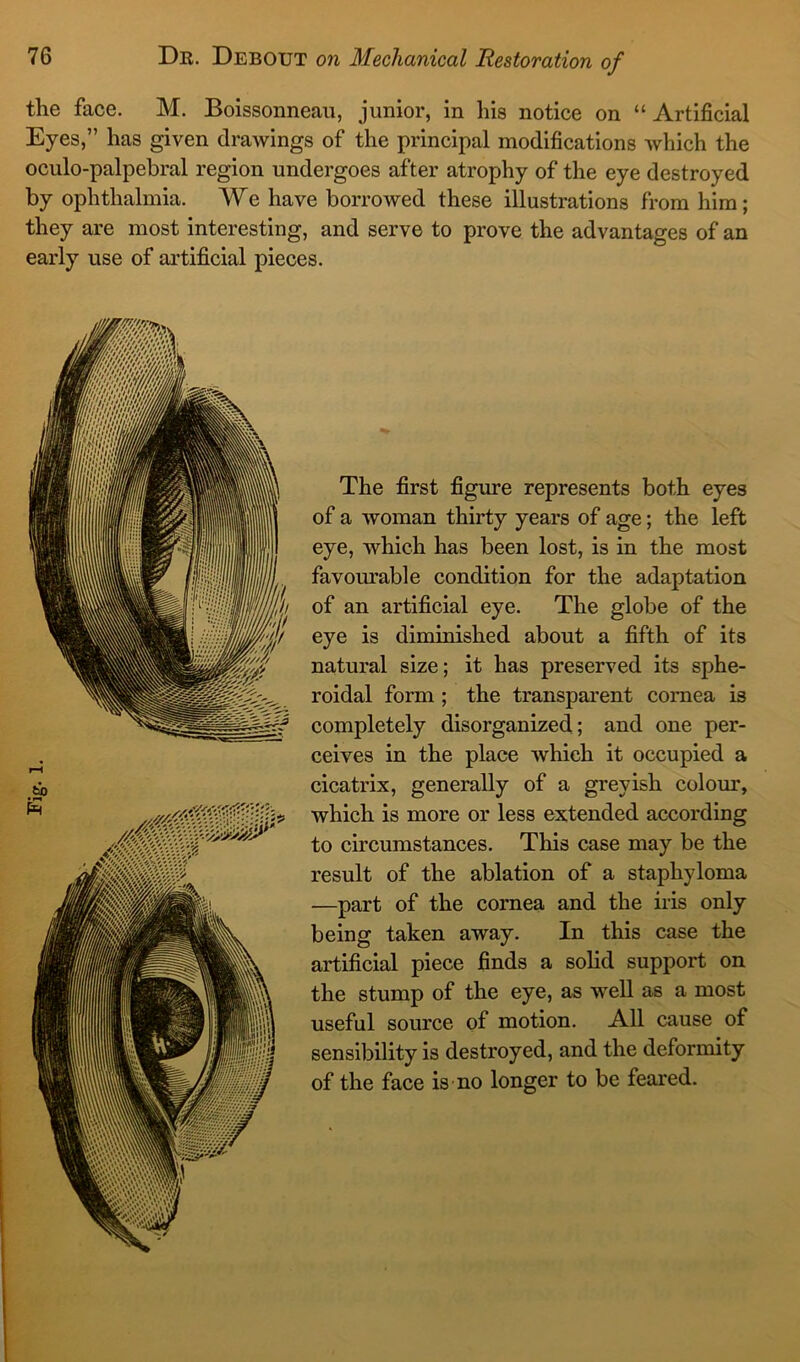 the face. M. Boissonneau, junior, in his notice on “ Artificial Eyes,” has given drawings of the principal modifications which the oculo-palpebral region undergoes after atrophy of the eye destroyed by ophthalmia. We have borrowed these illustrations from him; they are most interesting, and serve to prove the advantages of an early use of artificial pieces. The first figure represents both eyes of a woman thirty years of age; the left eye, which has been lost, is in the most favourable condition for the adaptation of an artificial eye. The globe of the eye is diminished about a fifth of its natural size; it has preserved its sphe- roidal form ; the transparent cornea is completely disorganized; and one per- ceives in the place which it occupied a cicatrix, generally of a greyish colour, which is more or less extended according to circumstances. This case may be the result of the ablation of a staphyloma —part of the cornea and the iris only being taken away. In this case the artificial piece finds a solid support on the stump of the eye, as well as a most useful source of motion. All cause of sensibility is destroyed, and the deformity of the face is no longer to be feared.