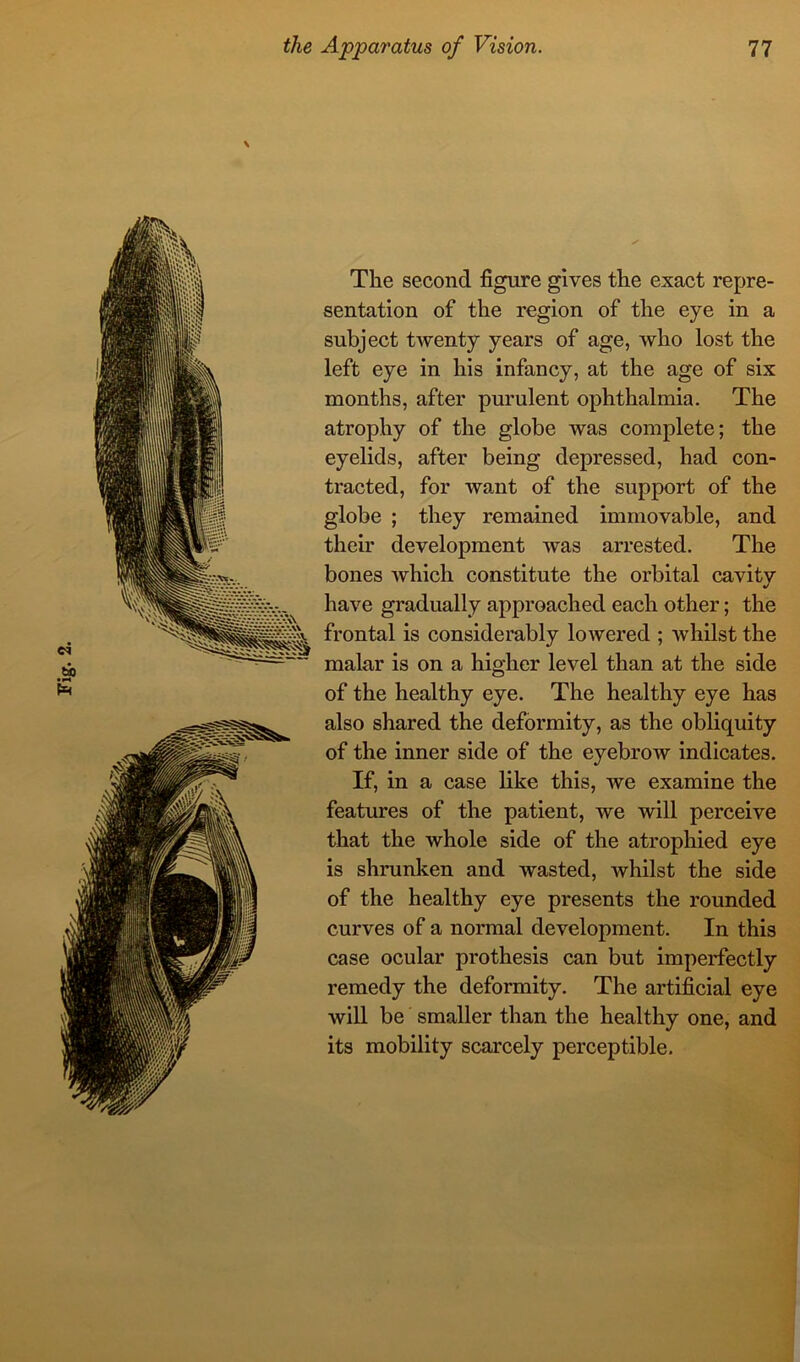 \ The second figure gives the exact repre- sentation of the region of the eye in a subject twenty years of age, who lost the left eye in his infancy, at the age of six months, after purulent ophthalmia. The atrophy of the globe was complete; the eyelids, after being depressed, had con- tracted, for want of the support of the globe ; they remained immovable, and their development was arrested. The bones which constitute the orbital cavity have gradually approached each other; the frontal is considerably lowered ; whilst the malar is on a higher level than at the side of the healthy eye. The healthy eye has also shared the deformity, as the obliquity of the inner side of the eyebrow indicates. If, in a case like this, we examine the features of the patient, we will perceive that the whole side of the atrophied eye is shrunken and wasted, whilst the side of the healthy eye presents the rounded curves of a normal development. In this case ocular prothesis can but imperfectly remedy the deformity. The artificial eye will be smaller than the healthy one, and its mobility scarcely perceptible.