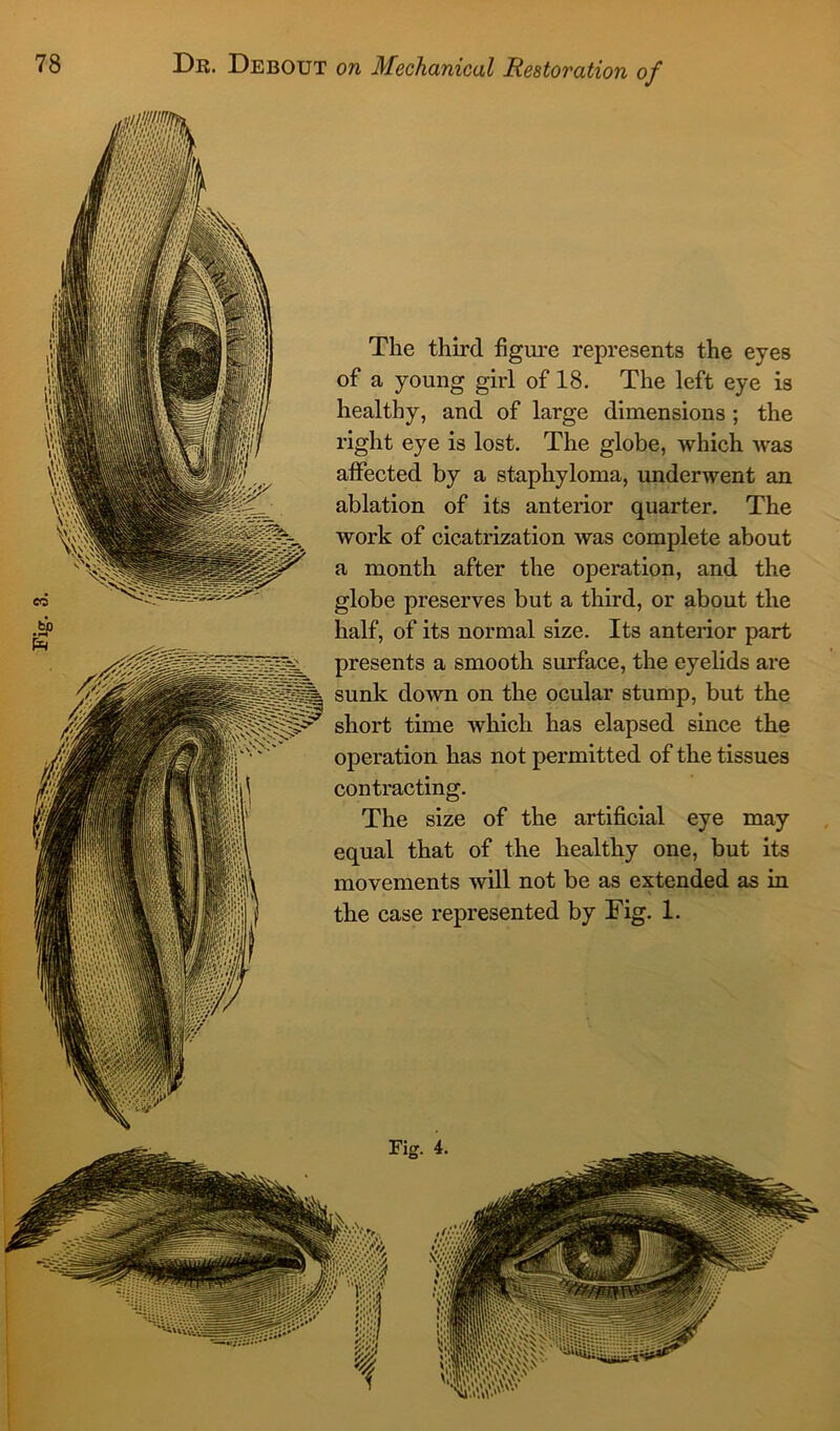 The third figure represents the eyes of a young girl of 18. The left eye is healthy, and of large dimensions ; the right eye is lost. The globe, which was affected by a staphyloma, underwent an ablation of its anterior quarter. The work of cicatrization was complete about a month after the operation, and the globe preserves but a third, or about the half, of its normal size. Its anterior part presents a smooth surface, the eyelids are sunk down on the ocular stump, but the short time which has elapsed since the operation has not permitted of the tissues contracting. The size of the artificial eye may equal that of the healthy one, but its movements will not be as extended as in the case represented by Fig. 1.