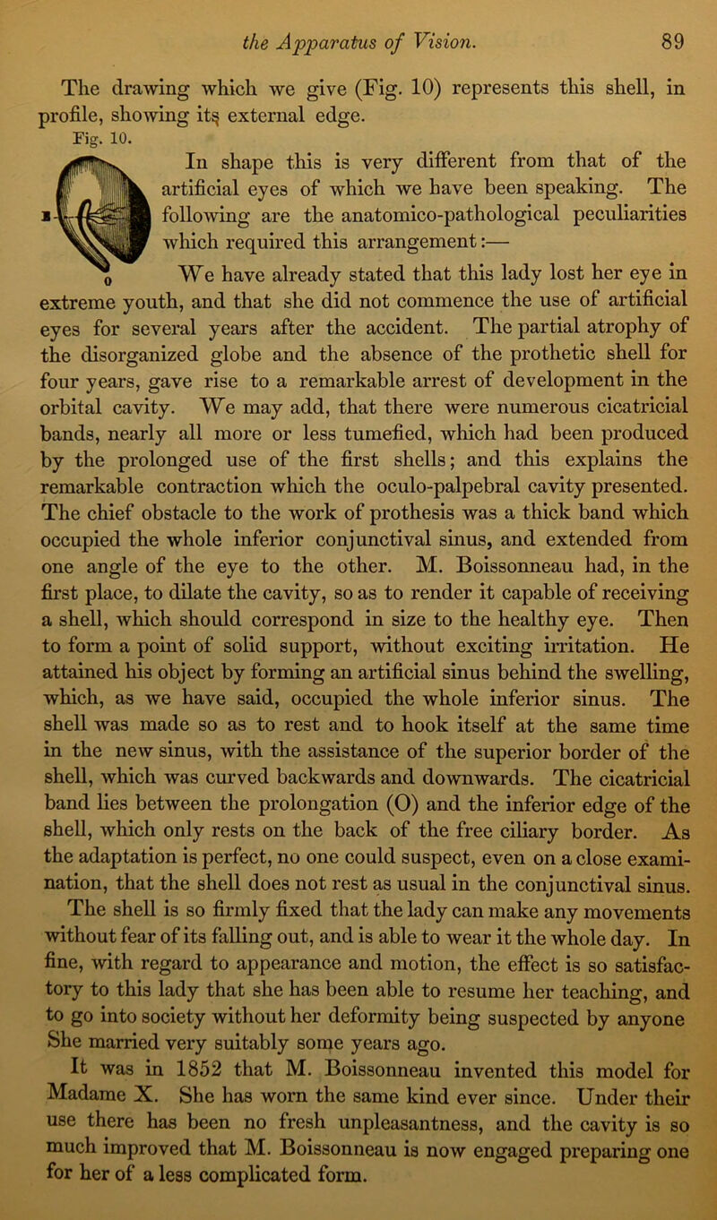 The drawing which we give (Fig. 10) represents this shell, in profile, showing it§ external edge. Fig. 10. In shape this is very different from that of the artificial eyes of which we have been speaking. The following are the anatomico-pathological peculiarities which required this arrangement:— We have already stated that this lady lost her eye in extreme youth, and that she did not commence the use of artificial eyes for several years after the accident. The partial atrophy of the disorganized globe and the absence of the prothetic shell for four years, gave rise to a remarkable arrest of development in the orbital cavity. We may add, that there were numerous cicatricial bands, nearly all more or less tumefied, which had been produced by the prolonged use of the first shells; and this explains the remarkable contraction which the oculo-palpebral cavity presented. The chief obstacle to the work of prothesis was a thick band which occupied the whole inferior conjunctival sinus, and extended from one angle of the eye to the other. M. Boissonneau had, in the first place, to dilate the cavity, so as to render it capable of receiving a shell, which should correspond in size to the healthy eye. Then to form a point of solid support, without exciting irritation. He attained his object by forming an artificial sinus behind the swelling, which, as we have said, occupied the whole inferior sinus. The shell was made so as to rest and to hook itself at the same time in the new sinus, with the assistance of the superior border of the shell, which was curved backwards and downwards. The cicatricial band lies between the prolongation (O) and the inferior edge of the shell, which only rests on the back of the free ciliary border. As the adaptation is perfect, no one could suspect, even on a close exami- nation, that the shell does not rest as usual in the conjunctival sinus. The shell is so firmly fixed that the lady can make any movements without fear of its falling out, and is able to wear it the whole day. In fine, with regard to appearance and motion, the effect is so satisfac- tory to this lady that she has been able to resume her teaching, and to go into society without her deformity being suspected by anyone She married very suitably some years ago. It was in 1852 that M. Boissonneau invented this model for Madame X. She has worn the same kind ever since. Under their use there has been no fresh unpleasantness, and the cavity is so much improved that M. Boissonneau is now engaged preparing one for her of a less complicated form.