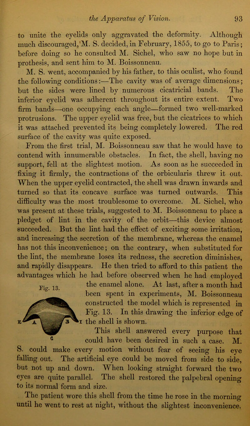 to unite the eyelids only aggravated the deformity. Although much discouraged,'M. S. decided, in February, 1855, to go to Paris; before doing so he consulted M. Sichel, who saw no hope but in prothesis, and sent him to M. Boissonneau. M. S. went, accompanied by his father, to this oculist, who found the following conditions:—The cavity was of average dimensions; but the sides were lined by numerous cicatricial bands. The inferior eyelid was adherent throughout its entire extent. Two firm bands—one occupying each angle—formed two well-marked protrusions. The upper eyelid was free, but the cicatrices to which it was attached prevented its being completely lowered. The red surface of the cavity was quite exposed. From the first trial, M. Boissonneau saw that he would have to contend with innumerable obstacles. In fact, the shell, having no support, fell at the slightest motion. As soon as he succeeded in fixing it firmly, the contractions of the orbicularis threw it out. When the upper eyelid contracted, the shell was drawn inwards and turned so that its concave surface was turned outwards. This difficulty was the most troublesome to overcome. M. Sichel, who was present at these trials, suggested to M. Boissonneau to place a pledget of lint in the cavity of the orbit—this device almost succeeded. But the lint had the effect of exciting some irritation, and increasing the secretion of the membrane, whereas the enamel has not this inconvenience; on the contrary, when substituted for the lint, the membrane loses its redness, the secretion diminishes, and rapidly disappears. He then tried to afford to this patient the advantages which he had before observed when he had employed the enamel alone. At last, after a month had been spent in experiments, M. Boissonneau constructed the model which is represented in Fig. 13. In this drawing the inferior edge of ki the shell is shown. This shell answered every purpose that could have been desired in such a case. M. S. could make every motion without fear of seeing his eye falling out. The artificial eye could be moved from side to side, but not up and down. When looking straight forward the two eyes are quite parallel. The shell restored the palpebral opening to its normal form and size. The patient wore this shell from the time he rose in the morning until he went to rest at night, without the slightest inconvenience. Tig. 13.