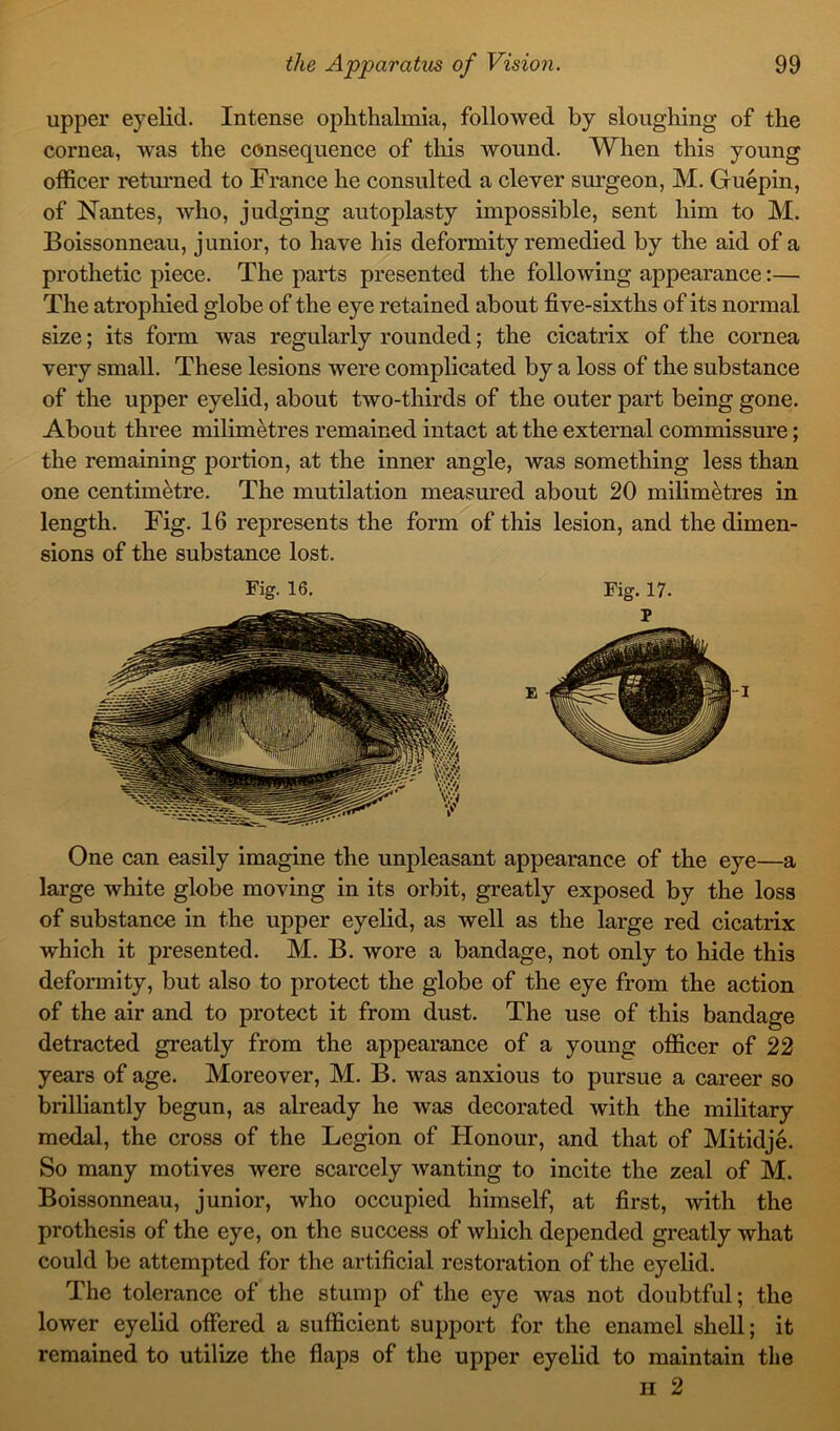upper eyelid. Intense ophthalmia, followed by sloughing of the cornea, was the consequence of this wound. When this young officer returned to France he consulted a clever surgeon, M. Guepin, of Nantes, who, judging autoplasty impossible, sent him to M. Boissonneau, junior, to have his deformity remedied by the aid of a prothetic piece. The parts presented the following appearance:— The atrophied globe of the eye retained about five-sixths of its normal size; its form was regularly rounded; the cicatrix of the cornea very small. These lesions were complicated by a loss of the substance of the upper eyelid, about two-thirds of the outer part being gone. About three milimetres remained intact at the external commissure; the remaining portion, at the inner angle, was something less than one centimetre. The mutilation measured about 20 milimetres in length. Fig. 16 represents the form of this lesion, and the dimen- sions of the substance lost. Fig. 16. Fig. 17. One can easily imagine the unpleasant appearance of the eye—a large white globe moving in its orbit, greatly exposed by the loss of substance in the upper eyelid, as well as the large red cicatrix which it presented. M. B. wore a bandage, not only to hide this deformity, but also to protect the globe of the eye from the action of the air and to protect it from dust. The use of this bandage detracted greatly from the appearance of a young officer of 22 years of age. Moreover, M. B. was anxious to pursue a career so brilliantly begun, as already he was decorated with the military medal, the cross of the Legion of Honour, and that of Mitidje. So many motives were scarcely wanting to incite the zeal of M. Boissonneau, junior, who occupied himself, at first, with the prothesis of the eye, on the success of which depended greatly what could be attempted for the artificial restoration of the eyelid. The tolerance of the stump of the eye was not doubtful; the lower eyelid offered a sufficient support for the enamel shell; it remained to utilize the flaps of the upper eyelid to maintain the n 2