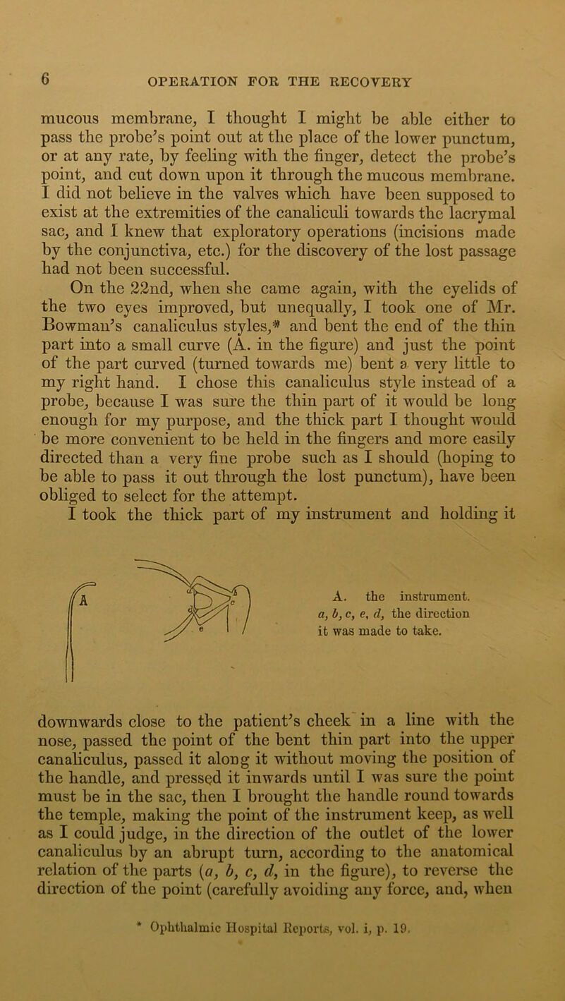 OPERATION FOR THE RECOVERY mucous membrane, I thought I might be able either to pass the probe’s point out at the place of the lower punctum, or at any rate, by feeling with the finger, detect the probe’s point, and cut clown upon it through the mucous membrane. I did not believe in the valves which have been supposed to exist at the extremities of the canaliculi towards the lacrymal sac, and 1 knew that exploratory operations (incisions made by the conjunctiva, etc.) for the discovery of the lost passage had not been successful. On the 22nd, when she came again, with the eyelids of the two eyes improved, but unequally, I took one of Mr. Bowman’s canaliculus styles,* and bent the end of the thin part into a small curve (A. in the figure) and just the point of the part curved (turned towards me) bent a very little to my right hand. I chose this canaliculus style instead of a probe, because I was sure the thin part of it would be long enough for my purpose, and the thick part I thought would be more convenient to be held in the fingers and more easily directed than a very fine probe such as I should (hoping to be able to pass it out through the lost punctum), have been obliged to select for the attempt. I took the thick part of my instrument and holding it A. the instrument. a, b, c, e, d, the direction it was made to take. downwards close to the patient’s cheek in a line with the nose, passed the point of the bent thin part into the upper canaliculus, passed it along it without moving the position of the handle, and pressed it inwards until I was sure the point must be in the sac, then I brought the handle round towards the temple, making the point of the instrument keep, as well as I could judge, in the direction of the outlet of the lower canaliculus by an abrupt turn, according to the anatomical relation of the parts (a, b, c, d, in the figure), to reverse the direction of the point (carefully avoiding any force, and, when * Ophthalmic Hospital Reports, vol. i, p. 19.