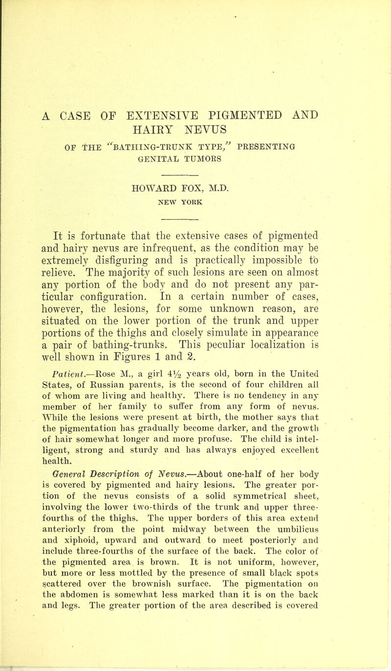 HAIEY NEVUS OF THE ‘BATHIHG-TKUNK TYPE/^ PRESENTING GENITAL TUMORS HOWARD FOX, M.D. NEW YORK It is fortunate that the extensive cases of pigmented and hairy nevus are infrequent, as the condition may be extremely disfiguring and is practically impossible to relieve. The majority of such lesions are seen on almost any portion of the body and do not present any par- ticular configuration. In a certain number of cases, however, the lesions, for some unknown reason, are situated on the lower portion of the trunk and upper portions of the thighs and closely simulate in appearance a pair of bathing-trunks. This peculiar localization is well shown in Figures 1 and 2. Patient.—Rose M., a girl 41/2 years old, born in the United States, of Russian parents, is the second of four children all of whom are living and healthy. There is no tendency in any member of her family to suffer from any form of nevus. While the lesions were present at birth, the mother says that the pigmentation has gradually become darker, and the growth of hair somewhat longer and more profuse. The child is intel- ligent, strong and sturdy and has always enjoyed excellent health. General Description of 'Nevus.—About one-half of her body is covered by pigmented and hairy lesions. The greater por- tion of the nevus consists of a solid symmetrical sheet, involving the lower two-thirds of the trunk and upper three- fourths of the thighs. The upper borders of this area extend anteriorly from the point midway between the umbilicus and xiphoid, upward and outward to meet posteriorly and include three-fourths of the surface of the back. The color of the pigmented area is brown. It is not uniform, however, but more or less mottled by the presence of small black spots scattered over the brownish surface. The pigmentation on the abdomen is somewhat less marked than it is on the back and legs. The greater portion of the area described is covered