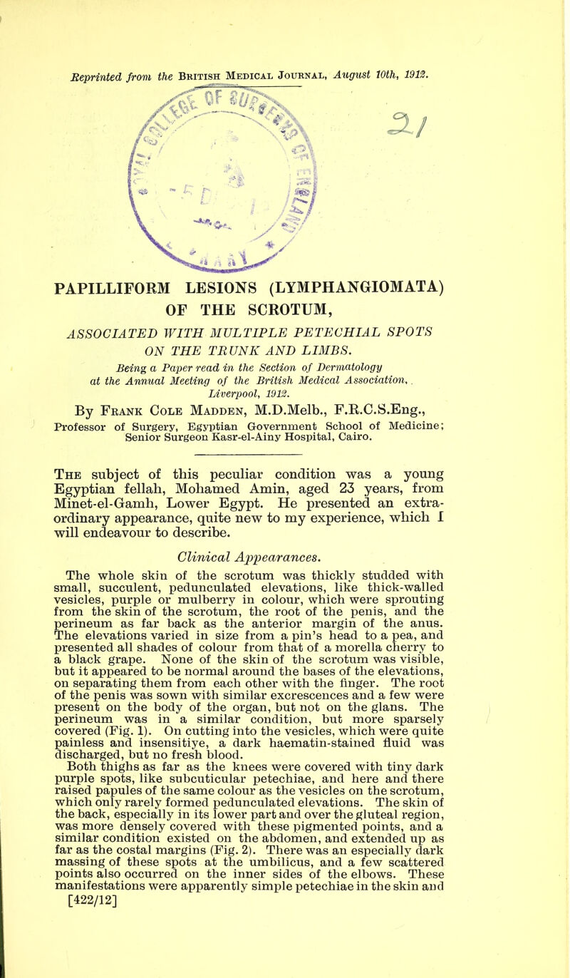 Reprinted from the Bkitish Medical Journal, August 10th, 1912. PAPILLIFORM LESIONS (LYMPHANGIOMATA) OF THE SCROTUM, ASSOCIATED WITH MULTIPLE PETECHIAL SPOTS ON THE TRUNK AND LIMBS. Being a Paper read in the Section of Dermatology at the Annual Meeting of the British Medical Association,. Liverpool, 1912. By Frank Cole Madden, M.D.Melb., F.R.C.S.Eng., Professor of Surgery, Egyptian Government School of Medicine; Senior Surgeon Kasr-el-Ainy Hospital, Cairo. The subject of this peculiar condition was a young Egyptian fellah, Mohamed Amin, aged 23 years, from Minet-el-Gamh, Lower Egypt. He presented an extra- ordinary appearance, quite new to my experience, which I will endeavour to describe. The whole skin of the scrotum was thickly studded with small, succulent, pedunculated elevations, like thick-walled vesicles, purple or mulberry in colour, which were sprouting from the skin of the scrotum, the root of the penis, and the perineum as far back as the anterior margin of the anus. The elevations varied in size from a pin’s head to a pea, and presented all shades of colour from that of a morella cherry to a black grape. None of the skin of the scrotum was visible, but it appeared to be normal around the bases of the elevations, on separating them from each other with the finger. The root of the penis was sown with similar excrescences and a few were present on the body of the organ, but not on the glans. The perineum was in a similar condition, but more sparsely covered (Fig. 1). On cutting into the vesicles, which were quite painless and insensitiye, a dark haematin-stained fluid was discharged, but no fresh blood. Both thighs as far as the knees were covered with tiny dark purple spots, like subcuticular petechiae, and here and there raised papules of the same colour as the vesicles on the scrotum, which only rarely formed pedunculated elevations. The skin of the back, especially in its lower part and over the gluteal region, was more densely covered with these pigmented points, and a similar condition existed on the abdomen, and extended up as far as the costal margins (Fig. 2). There was an especially dark massing of these spots at the umbilicus, and a few scattered points also occurred on the inner sides of the elbows. These manifestations were apparently simple petechiae in the skin and Clinical Appearances, [422/12]