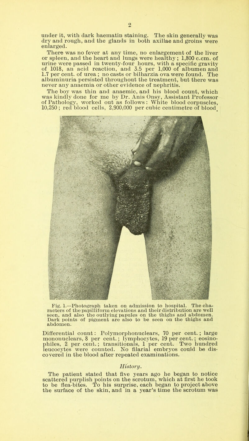 under it, with dark haematin staining. The skin generally was dry and rough, and the glands in both axillae and groins were enlarged. There was no fever at any time, no enlargement of the liver or spleen, and the heart and lungs were healthy ; 1,800 c.cm. of urine were passed in twenty-four hours, with a specific gravity of 1018, an acid reaction, and 3.5 per 1,000 of albumen and 1.7 per cent, of urea ; no casts or bilharzia ova were found. The albuminuria persisted throughout the treatment, but there was never any anaemia or other evidence of nephritis. The boy was thin and anaemic, and his blood count, which was kindly done for me by Dr. Anis Onsy, Assistant Professor of Pathology, worked out as follows: White blood corpuscles, 10,250 ; red blood cells, 2,900,000 per cubic centimetre of blood. Fig. 1.—Photograph taken on admission to hospital. The cha- racters of the papilliform elevations and their distribution are well seen, and also the outlying papules on the thighs and abdomen. Dark points of pigment are also to be seen on the thighs and abdomen. Differential count: Polymorphonuclears, 70 per cent.; large mononuclears, 8 per cent.; lymphocytes, 19 per cent.; eosino- philes, 2 per cent.; transitionals, 1 per cent. Two hundred leucocytes were counted. No filarial embryos could be dis- covered in the blood after repeated examinations. History. The patient stated that five years ago he began to notice scattered purplish points on the scrotum, which at first he took to be flea-bites. To his surprise, each began to project above the surface of the skin, and in a year’s time the scrotum was