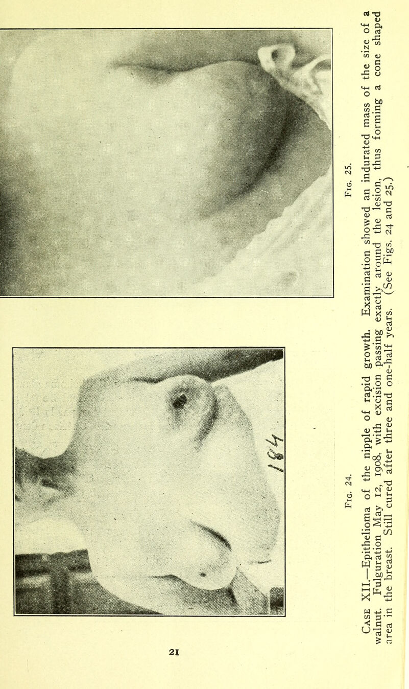 Case XII.—Epithelioma of the nipple of rapid growth. Examination showed an indurated mass of the size of a walnut. Fulguration May 12, 1908, with excision passing exactly around the lesion, thus forming a cone shaped area in the breast. Still cured after three and one-half years. (See Figs. 24 and 25.)