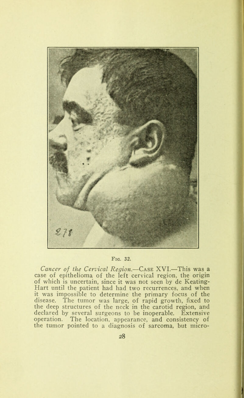 Fig. 32. Cancer of the Cervical Region.—Case XVI.—This was a case of epithelioma of the left cervical region, the origin of which is uncertain, since it was not seen by de Keating- Hart until the patient had had two recurrences, and when it was impossible to determine the primary focus of the disease. The tumor was large, of rapid growth, fixed to the deep structures of the neck in the carotid region, and declared by several surgeons to be inoperable. Extensive operation. The location, appearance, and consistency of the tumor pointed to a diagnosis of sarcoma, but micro-