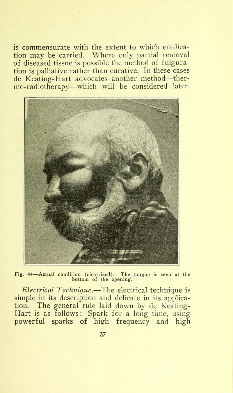 is commensurate with the extent to which eradica- tion may be carried. Where only partial removal of diseased tissue is possible the method of figura- tion is palliative rather than curative. In these cases de Keating-Hart advocates another method—ther- mo-radiotherapy—which will be considered later. Fig. 44—Actual condition (cicatrized). The tongue is seen at the bottom of the opening. Electrical Technique.—The electrical technique is simple in its description and delicate in its applica- tion. The general rule laid down by de Keating- Hart is as follows: Spark for a long time, using powerful sparks of high frequency and high