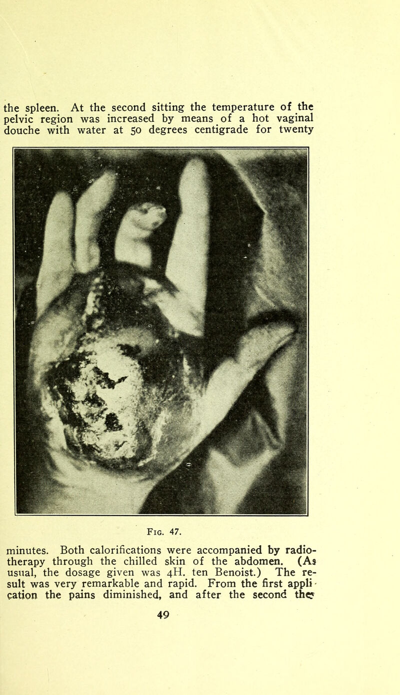 the spleen. At the second sitting the temperature of the pelvic region was increased by means of a hot vaginal douche with water at 50 degrees centigrade for twenty Fig. 47. minutes. Both calorifications were accompanied by radio- therapy through the chilled skin of the abdomen. (As usual, the dosage given was 4H. ten Benoist.) The re- sult was very remarkable and rapid. From the first appli cation the pains diminished, and after the second th$?