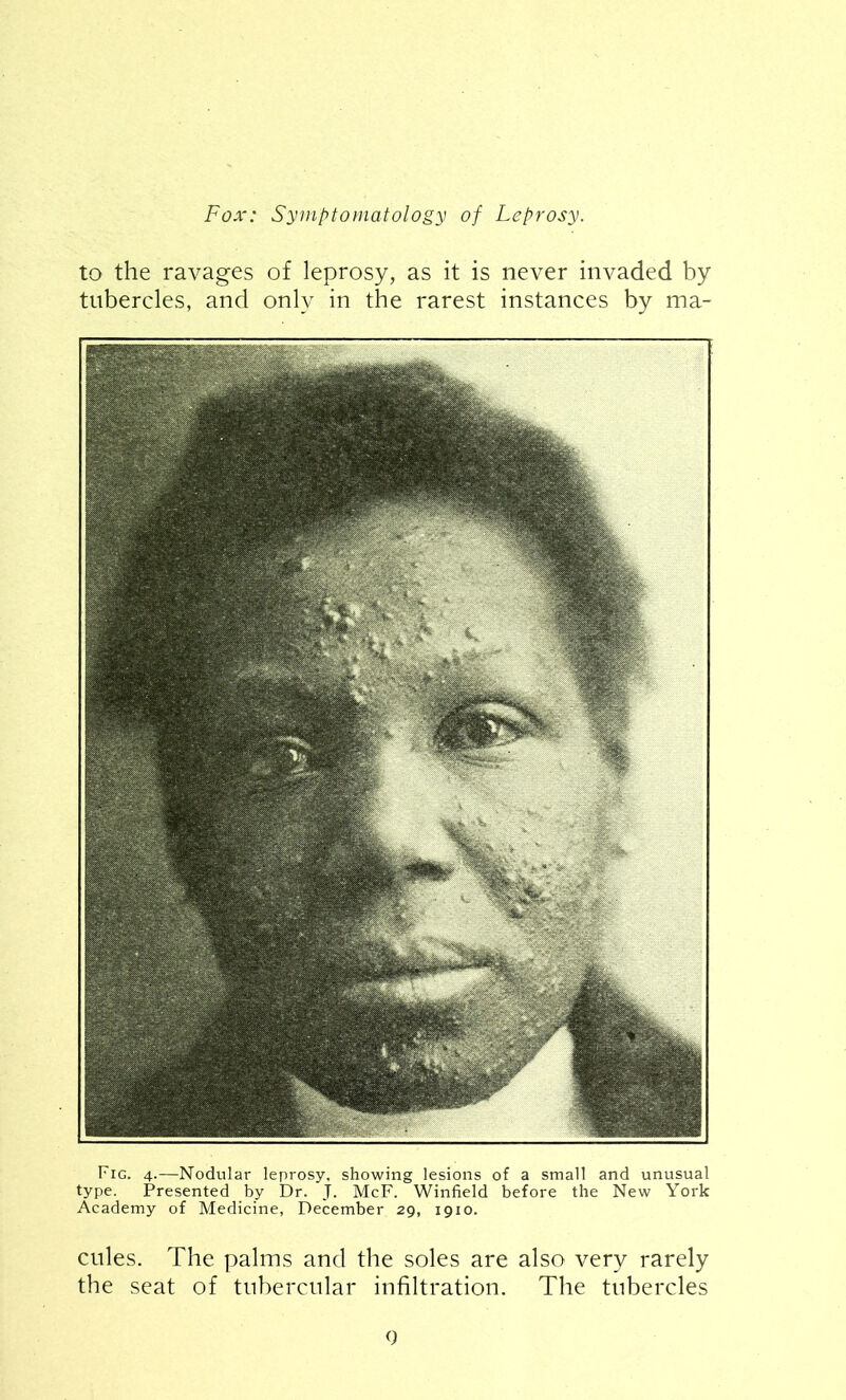 to the ravages of leprosy, as it is never invaded by tubercles, and only in the rarest instances by ma- Fig. 4.—Nodular leprosy, showing lesions of a small and unusual type. Presented by Dr. J. McF. Winfield before the New York Academy of Medicine, December 29, 1910. cules. The palms and the soles are also very rarely the seat of tubercular infiltration. The tubercles