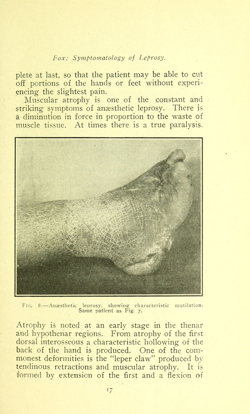 plete at last, so that the patient may be able to cut off portions of the hands or feet without experi- encing the slightest pain. Muscular atrophy is one of the constant and striking symptoms of anaesthetic leprosy. There is a diminution in force in proportion to the waste of muscle tissue. At times there is a true paralysis. Fig. 8.—Anaesthetic leprosy, showing characteristic mutilation. Same patient as Fig. 7. Atrophy is noted at an early stage in the thenar and hypothenar regions. From atrophy of the first dorsal interosseous a characteristic hollowing of the back of the hand is produced. One of the com- monest deformities is the “leper claw” produced by tendinous retractions and muscular atrophy. It is formed by extension of the first and a flexion of