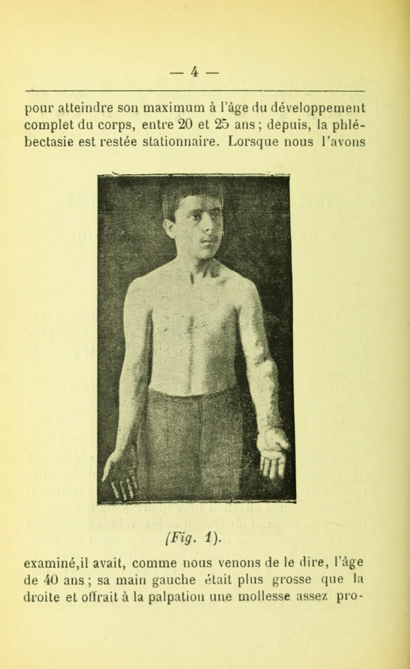 pour atteindre son maximum à l’âge du développement complet du corps, entre 20 et 25 ans; depuis, la phlé- bectasie est restée stationnaire. Lorsque nous l’avons (Fig. i). examiné,il avait, comme nous venons de le dire, l’âge de 40 ans; sa main gauche était plus grosse que la droite et olïrait à la palpation une mollesse assez pro-