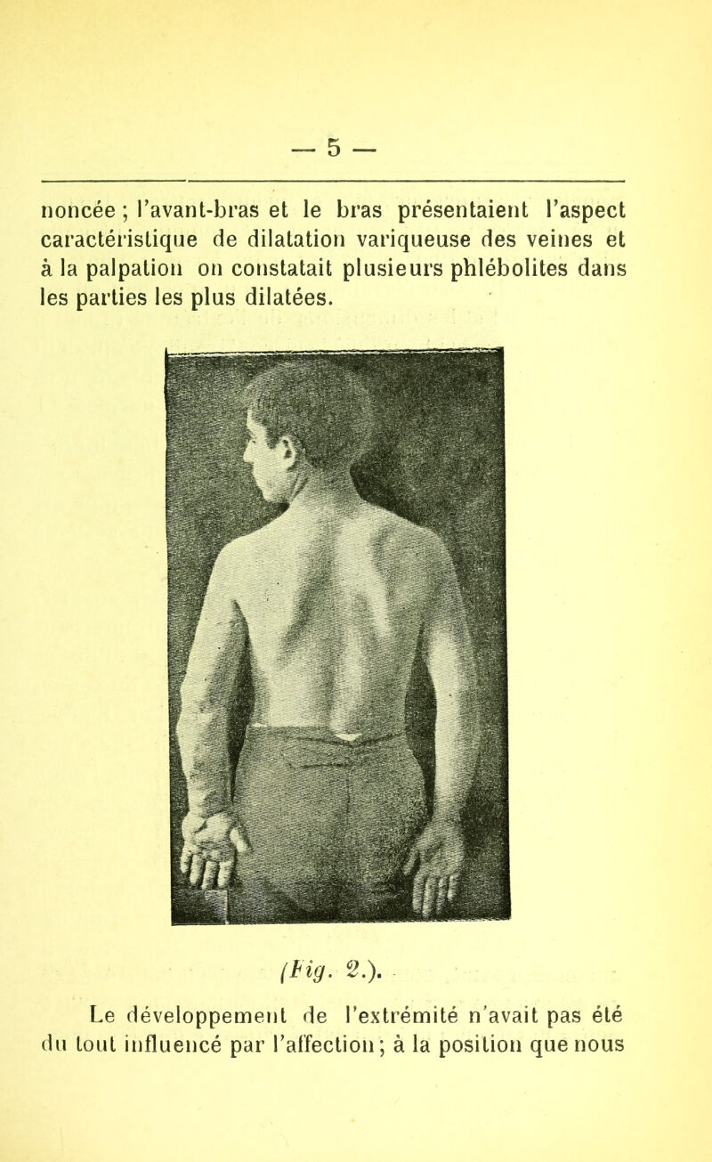 noncée ; Tavant-bras et le bras présentaient l’aspect caractéristique de dilatation variqueuse des veines et à la palpation on constatait plusieurs phlébolites dans les parties les plus dilatées. (Fig. 2,), Le développement de l’extrémité n’avait pas été du tout influencé par l’affection; à la position que nous