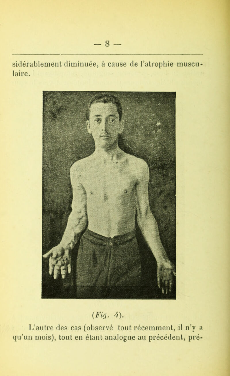 sidérablement diminuée, à cause de l’atrophie muscu- laire. (Fig. 4). L’autre des cas (observé tout récemment, il n’y a qu’un mois), tout en étant analogue au précédent, pré-