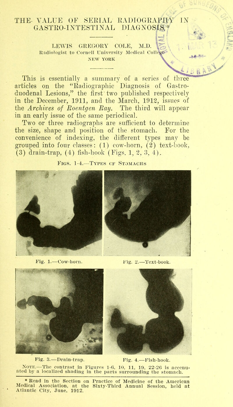 THE- VALUE OF SERIAL RADIOGRAPHY GASTROINTESTINAL DIAGNOSIS,* IN LEWIS GREGORY COLE, M.D. •' Radiologist to Cornell University Medical College NEW YORK This is essentially a summary of a series of three articles on the “Radiographic Diagnosis of Gastro- duodenal Lesions/’ the first'two published respectively in the December, 1911, and the March, 1912, issues of the Archives of Roentgen Ray. The third will appear in an early issue of the same periodical. Two or three radiographs are sufficient to determine the size, shape and position of the stomach. For the convenience of indexing, the different types may be grouped into four classes: (1) cow-horn, (2) text-book, (3) drain-trap, (4) fish-hook (Figs. 1, 2, 3, 4). Figs. 1-4.—Types cf Stomachs Fig. 1.—Cow-horn. Fig. 2.—Text-book. Fig. 3.—Drain-trap. Fig. 4.—Fish-hook. Note.—The contrast in Figures 1-6, 10, 11, 19, 22-26 is accenu- ated by a localized shading in the parts surrounding the stomach. * Read in the Section on Practice of Medicine of the American Medical Association, at the Sixty-Third Annual Session, held at Atlantic City, June, 1912.