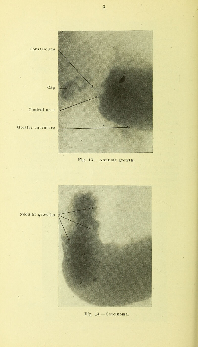 Fig. 14.—Cfii'cinoma.