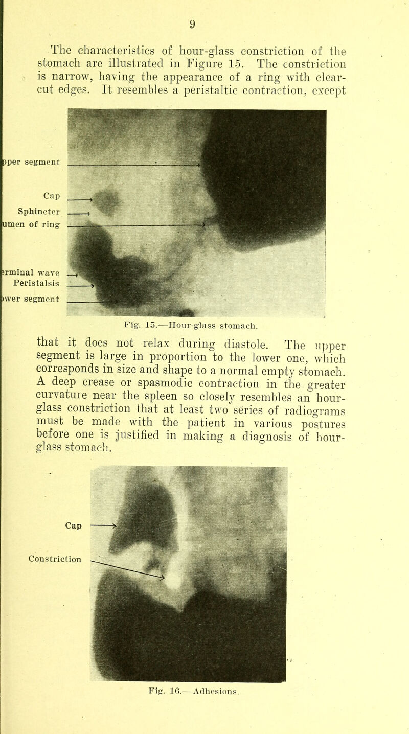 The characteristics of hour-glass constriction of the stomach are illustrated in Figure 15. The constriction is narrow, having the appearance of a ring with clear- cut edges. It resembles a peristaltic contraction, except pper segment Cap Sphincter iimen of ring ;rminal wave Peristalsis >wer segment Fig. 15.—Hour-glass stomach. that it does not relax during diastole. The upper segment is large in proportion to the lower one, which corresponds in size and shape to a normal empty stomach. A deep crease or spasmodic contraction in the . greater curvature near the spleen so closely resembles an hour- glass constriction that at least two series of radiograms must be made with the patient in various postures before one is justified in making a diagnosis of hour- glass stomach. Fig. 16.—Adhesions.