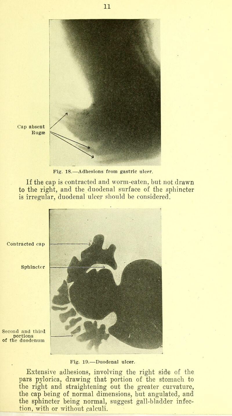 Fig. 18.—Adhesions from gastric ulcer. If the cap is contracted and worm-eaten, but not drawn to the right, and the duodenal surface of the sphincter is irregular, duodenal ulcer should be considered. Contracted cap Sphincter Second and third portions of the duodenum Fig. 19.—Duodenal ulcer. Extensive adhesions, involving the right side of the pars pylorica, drawing that portion of the stomach to the right and straightening out the greater curvature, the cap being of normal dimensions, but angulated, and the sphincter being normal, suggest gall-bladder infec- tion, with or without .calculi.