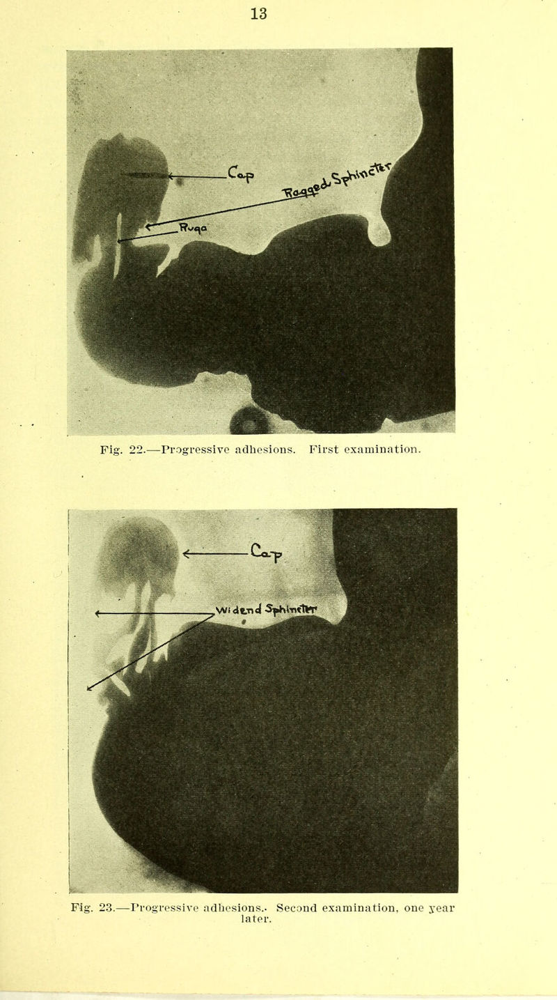 Fig. 23.—Progressive adhesions.- Second examination, one year later.