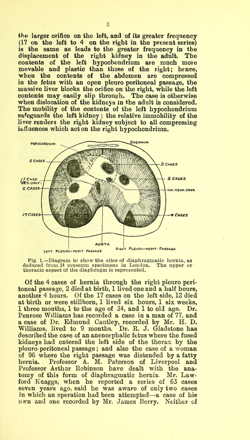 the larger orifice on the left, and of its greater frequency (17 on the left to 4 on the right in the present series) is the same as leads to the greater frequency in the displacement of the right kidney in the adult. The contents of the left hypochondrium are much more movable and plastic than those of the right; hence, ■when the contents of the abdomen are compressed in the fetus with an open pleuro peritoneal passage, the massive liver blocks the orifice on the right, while the left contents may easily slip through. The case is otherwise when dislocation of the kidneys in the adult is considered. The mobility of the contents of the left hypochondrium safeguards the left kidney ; the relative immobility of the liver renders the right kidney subject to all compressing influences which acton the right hypochondrium. AORTA LEFT PLEURO-PERIT PASSAGE Right Pleuro-per it-. Passage Pig. 1.—Diagram to show the sites of diaphragmatic hernia, as deduced from 34 museum specimens in London. The upper or thoracic aspect of the diaphragm is represented. Of the 4 cases of hernia through the right pleuro peri- toneal passage, 2 died at birth, 1 lived one and a half hours, another 4 hours. Of the 17 cases on the left side, 12 died at birth or were stillborn, 1 lived six hours, 1 six weeks, 1 three months, 1 to the age of 34, and 1 to old age. Dr. Penrose Williams has recorded a case in a man of 77, and a case of Dr. Edmund Cautley, recorded by Mr. H. D. Williams, lived to 9 months. Dr. R. J. Gladstone has described the case of an anencephalic fetus where the fused kidneys had entered the left side of the thorax by the pleuro- peritoneal passage ; and also the case of a woman of 96 where the right passage was distended by a fatty hernia. Professor A. M. Paterson of Liverpool and Professor Arthur Robinson have dealt with the ana- tomy of this form of diaphragmatic hernia. Mr. Law- ford Kuaggs, when he reported a series of 63 cases seven years ago, said he was aware of only two cases in which an operation had been attempted—a case of his own and one recorded by Mr. James Berry. Neither of