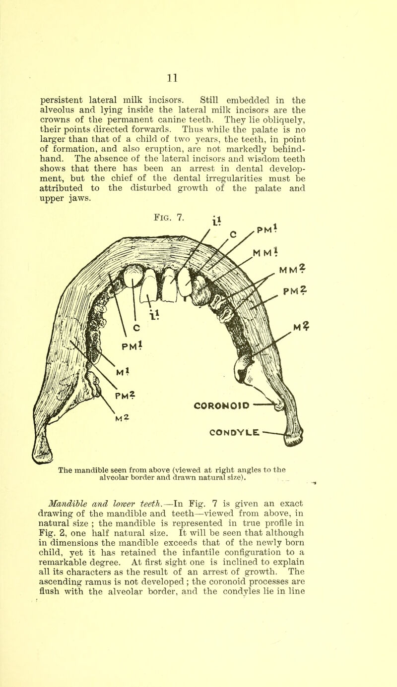 persistent lateral milk incisors. Still embedded in the alveolus and lying inside the lateral milk incisors are the crowns of the permanent canine teeth. They lie obliquely, their points directed forwards. Thus while the palate is no larger than that of a child of two years, the teeth, in point of formation, and also eruption, are not markedly behind- hand. The absence of the lateral incisors and wisdom teeth shows that there has been an arrest in dental develop- ment, but the chief of the dental irregularities must be attributed to the disturbed growth of the palate and upper jaws. The mandible seen from above (viewed at right angles to the alveolar border and drawn natural size). Mandible and lower teeth.—In Fig. 7 is given an exact drawing of the mandible and teeth—viewed from above, in natural size ; the mandible is represented in true profile in Fig. 2, one half natural size. It will be seen that although in dimensions the mandible exceeds that of the newly born child, yet it has retained the infantile configuration to a remarkable degree. At first sight one is inclined to explain all its characters as the result of an arrest of growth. The ascending ramus is not developed; the coronoid processes are flush with the alveolar border, and the condyles lie in line