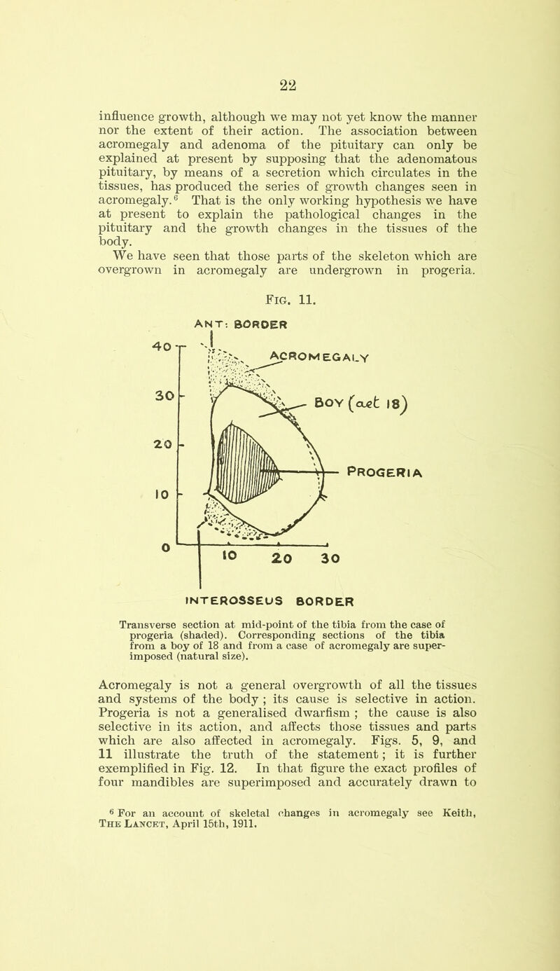 influence growth, although we may not yet know the manner nor the extent of their action. The association between acromegaly and adenoma of the pituitary can only be explained at present by supposing that the adenomatous pituitary, by means of a secretion which circulates in the tissues, has produced the series of growth changes seen in acromegaly.6 That is the only working hypothesis we have at present to explain the pathological changes in the pituitary and the growth changes in the tissues of the body. We have seen that those parts of the skeleton which are overgrown in acromegaly are undergrown in progeria. Fig. 11. ANT: border Transverse section at mid-point of the tibia from the case of progeria (shaded). Corresponding sections of the tibia from a boy of 18 and from a case of acromegaly are super- imposed (natural size). Acromegaly is not a general overgrowth of all the tissues and systems of the body ; its cause is selective in action. Progeria is not a generalised dwarfism ; the cause is also selective in its action, and affects those tissues and parts which are also affected in acromegaly. Figs. 5, 9, and 11 illustrate the truth of the statement; it is further exemplified in Fig. 12. In that figure the exact profiles of four mandibles are superimposed and accurately drawn to 6 For an account of skeletal changes in acromegaly see Keith, The Lancet, April 15th, 1911.