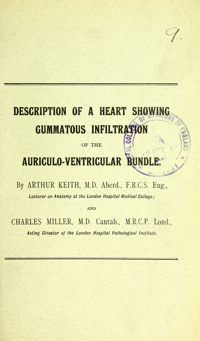 c DESCRIPTION OF A HEART SHOWING GUMMATOUS INFILTRffiBON I#1 OF THE AURICULO-VENTRICULAR BUNDLE; « By ARTHUR KEITH, M.D. Aberd., F.R.C.S. Eng., Lecturer on Anatomy at the London Hospital Medical College; - ■ - -■ ' ■ ' . ,  AND / / * kJ CHARLES MILLER, M.D. Cantab., M.R.C.P. bond., Acting Director of the London Hospital Pathological Institute.